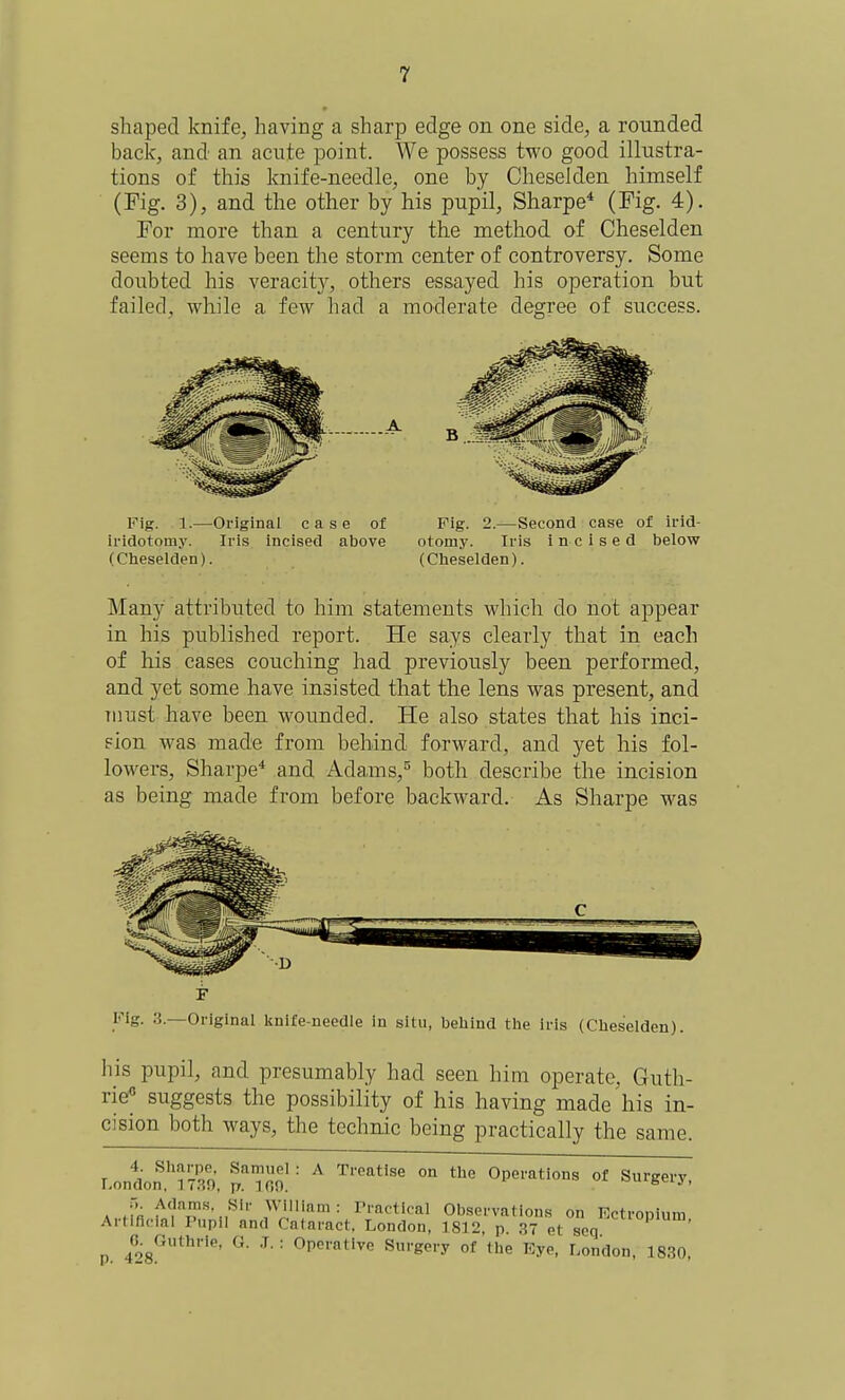 shaped knife, having a sharp edge on one side, a rounded back, and an acute point. We possess two good illustra- tions of this knife-needle, one by Cheselden himself (Fig. 3), and the other by his pupil, Sharpe* (Pig. 4). Por more than a century the method of Cheselden seems to have been the storm center of controversy. Some doubted his veracity, others essayed his operation but failed. while a few had a moderate degree of success. Fig. 1.—Original case of iridotomy. Iris incised above (Cheselden). Fig. 2.—Second case of irid- otomy. Iris incised below (Cheselden). Many attributed to him statements which do not appear in his published report. He says clearly that in each of his cases couching had previously been performed, and yet some have insisted that the lens was present, and must have been wounded. He also states that his inci- Fion was made from behind forward, and yet his fol- lowers, Sharpe* and Adams,both describe the incision as being made from before backward. As Sharpe was Fig. 3.—Original Icuife-ueedle in situ, behind the iris (Cheselden). his pupil, and presumably had seen him operate, Guth- rie suggests the possibility of his having made his in- cision both ways, the technic being practically the same. 4 Sharpe Samuel: A Treatise on the Operations of Surgery London, 1730, p. 100. ouigeij, A.;/fl ^'?'\?'-„^'' • r'ractical Observations on Ectropium Artificial Pupil and Cataract. London, 1SJ2, p 37 et soq ^ ' p. 428.^*^''' ^' ^' '' ^'■eei'y °f Eye, London, 1830,