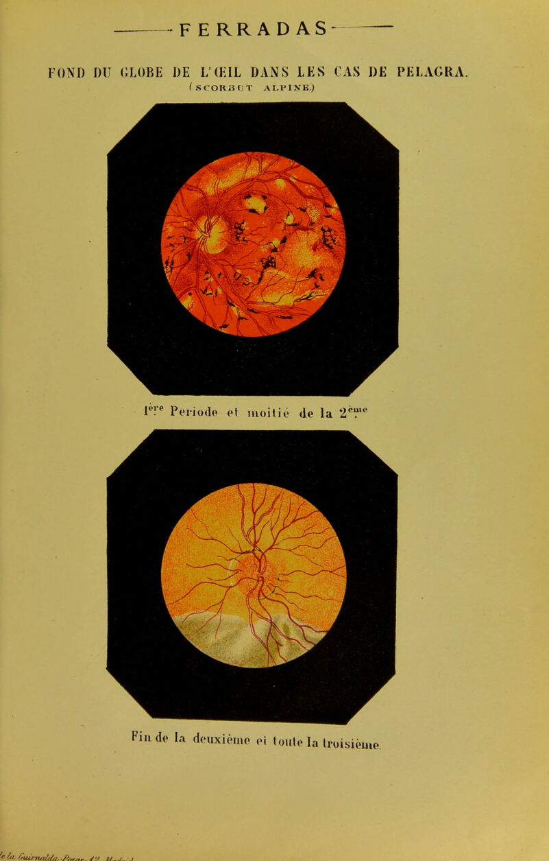 -FERRADAS- FOND DU GLOBE DE L'ŒIL DANS LES (AS DE PELAGRA. (scOKHfJT ALPINE.) FV^ Période et moitié de la 2*?' nde la deuxième oi foule la troisième.