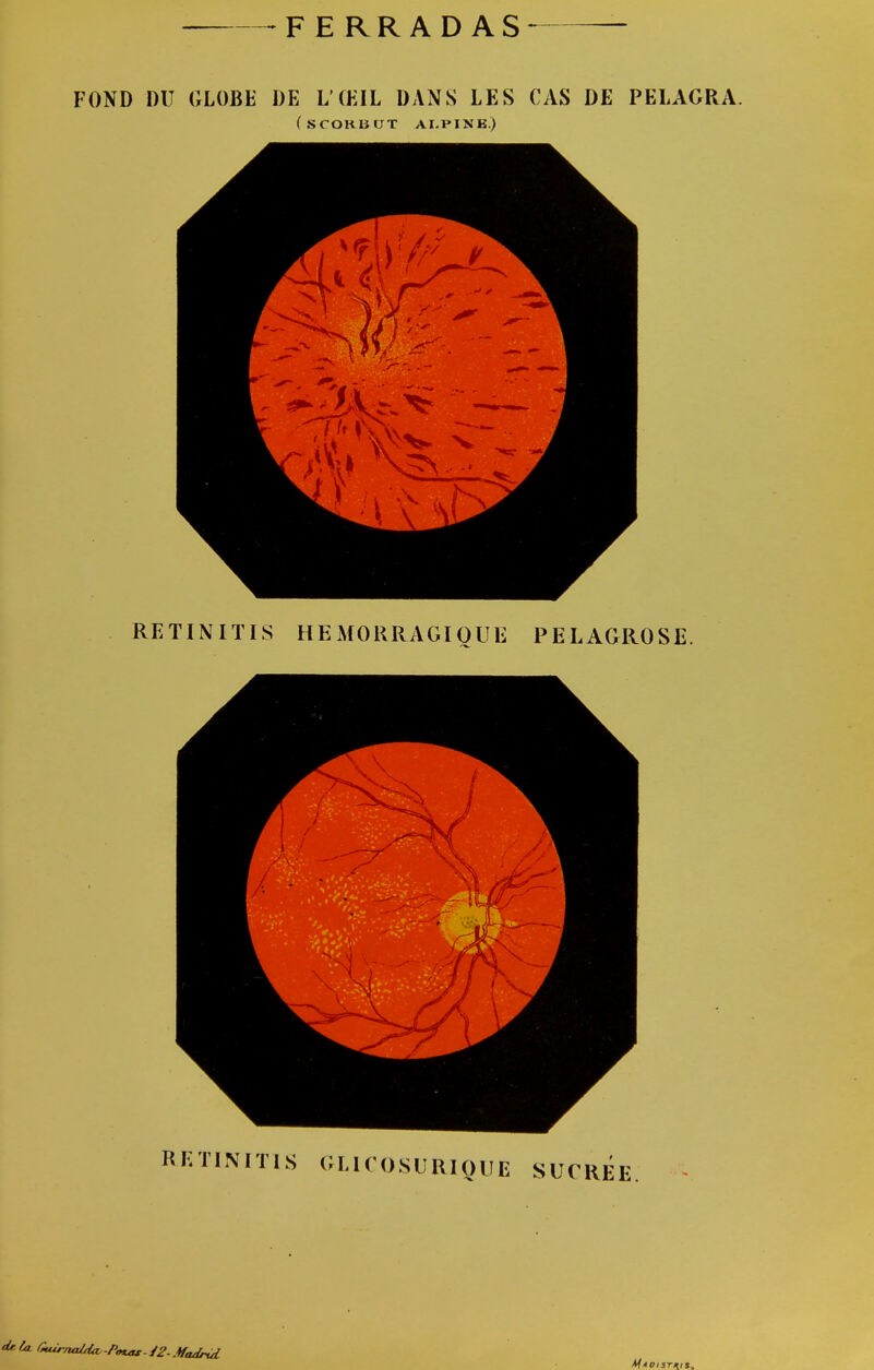 FE RRADAS FOND DU GLOBE DE L'ŒIL DANS LES CAS DE PELAGRA. (scorbut alpine.) RETINITIS HEMORRAGIQUE PELAGROSE. RETINIÏIS GLICOSURIQUE SUCREE