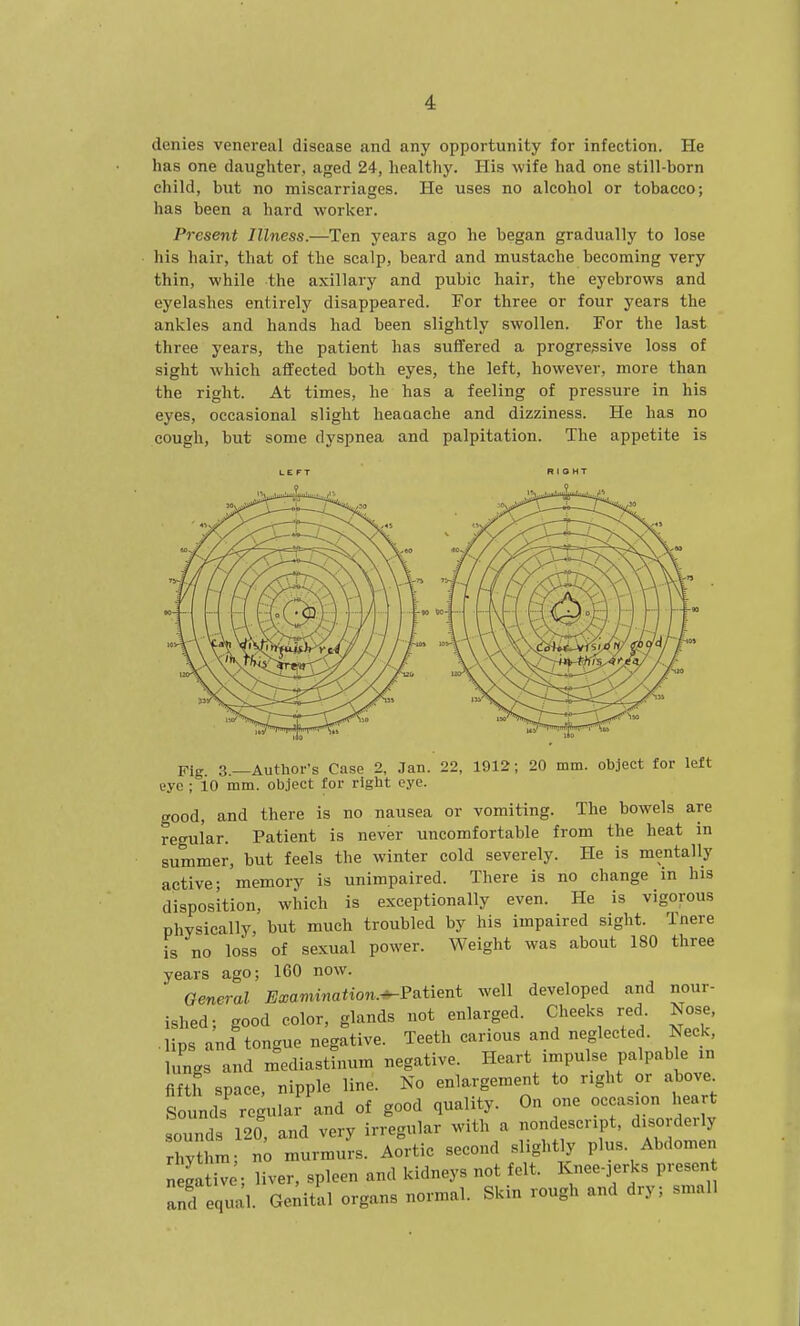denies venereal disease and any opportunity for infection. He has one daughter, aged 24, healthy. His wife had one still-born child, but no miscarriages. He uses no alcohol or tobacco; has been a hard worker. Present Illness.—Ten years ago he began gradually to lose his hair, that of the scalp, beard and mustache becoming very thin, while the axillary and pubic hair, the eyebrows and eyelashes entirely disappeared. For three or four years the ankles and hands had been slightly swollen. For the last three years, the patient has suffered a progressive loss of sight Avhich affected both eyes, the left, however, more than the right. At times, he has a feeling of pressure in his eyes, occasional slight heaaache and dizziness. He has no cough, but some dyspnea and palpitation. The appetite is Fig. 3.—Author's Case 2, Jan. 22, 1912; 20 mm. object for left eye ; 10 mm. object for right eye. good, and there is no nausea or vomiting. The bowels are regular. Patient is never uncomfortable from the heat in summer, but feels the winter cold severely. He is mentally active; memory is unimpaired. There is no change in his disposition, which is exceptionally even. He is vigorous physically, but much troubled by his impaired sight. Tnere is no loss of sexual power. Weight was about 180 three years ago; 160 now. General Examination.-^Patient well developed and nour- ished; good color, glands not enlarged. Cheeks red Nose, .lips and tongue negative. Teeth carious and neglected. Neck lungs and mediastinum negative. Heart impulse palpable in fifth space, nipple line. No enlargement to right or above Sounds regular and of good quality. On one occasion heart sounds 120 and very irregular with a nondescript, disorderly hy^l m n^ murmurs. Aortic second slightly plus. Abdomen nega iv ; liver, spleen and kidneys not felt. Knee-jerks presen and equal. Genital organs normal. Skin rough and dry; small