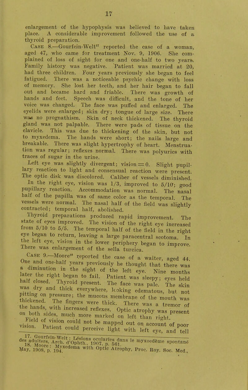 enlargement of the hypophysis was believed to have taken place. A considerable improvement followed the use of a thyroid preparation. Case 8.—Gourfein-Welt reported the case of a woman, aged 47, who came for treatment Nov. 9, 1906. She com- plained of loss of sight for one and one-half to two years-. Family history was negative. Patient was married at 20, had three children. Four years previously she began to feel fatigued. There was a noticeable psychic change with loss of memory. She lost her teeth, and her hair began to fall out and became hard and friable. There was growth of hands and feet. Speech was difficult, and the tone of her voice was changed. The face was puffed and enlarged. The eyelids were enlarged; skin dry; tongue of large size. There was no prognathism. Skin of neck thickened. The thyroid gland was not palpable. There were pads of tissue on the clavicle. This was due to thickening of the skin, but not to myxedema. The hands were short; the nails large and breakable. There was slight hypertrophy of heart. Menstrua- tion was regular; reflexes normal. There was polyurics with traces of sugar in the urine. Left eye was slightly divergent; vision = 0. Slight pupil- lary reaction to light and consensual reaction were present. The optic disk was discolored. Caliber of vessels diminished. In the right eye, vision was 1/3, improved to 5/10; good pupillary reaction. Accommodation was normal. The nasal half of the papilla was of same color as the temporal The vessels were normal. The nasal half of the field was slightly contracted; temporal half, abolished. Thyroid preparations produced rapid improvement The state of eyes improved. The vision of the right eye increased from 5/10 to 5/5. The temporal half of the field in the right eye began to return, leaving a large paracentral scotoma. In the left eye, vision in the lower periphery began to improve. Xhere was enlargement of the sella turcica. Case 9.-Moore reported the case of a waiter, aged 44. One and one-half years previously he thought that there was LprTr I/? tl^\«ight of the left eye. Nine months later the right began to fail. Patient was sleepy; eyes held half closed. Thyroid present. The face was pa^e. Ti e k n was dry and thick everywhere, looking edematous, but not T ^ITZ''' membrape of the mouth was Z Zt thick. There was a tremor o the hands, with increased reflexes. Optic atrophy was present on both sides, much more marked on left than right ^ visbn '^PP^'^ °^ ^«««t of poor ^^^^^on^Ji^Ue^ perceive light with left eye, and tell ¥ay 1908,%: iS''''^''^ ^'^ Opt'-' atrophy, Proc. Roy. See. Med.,