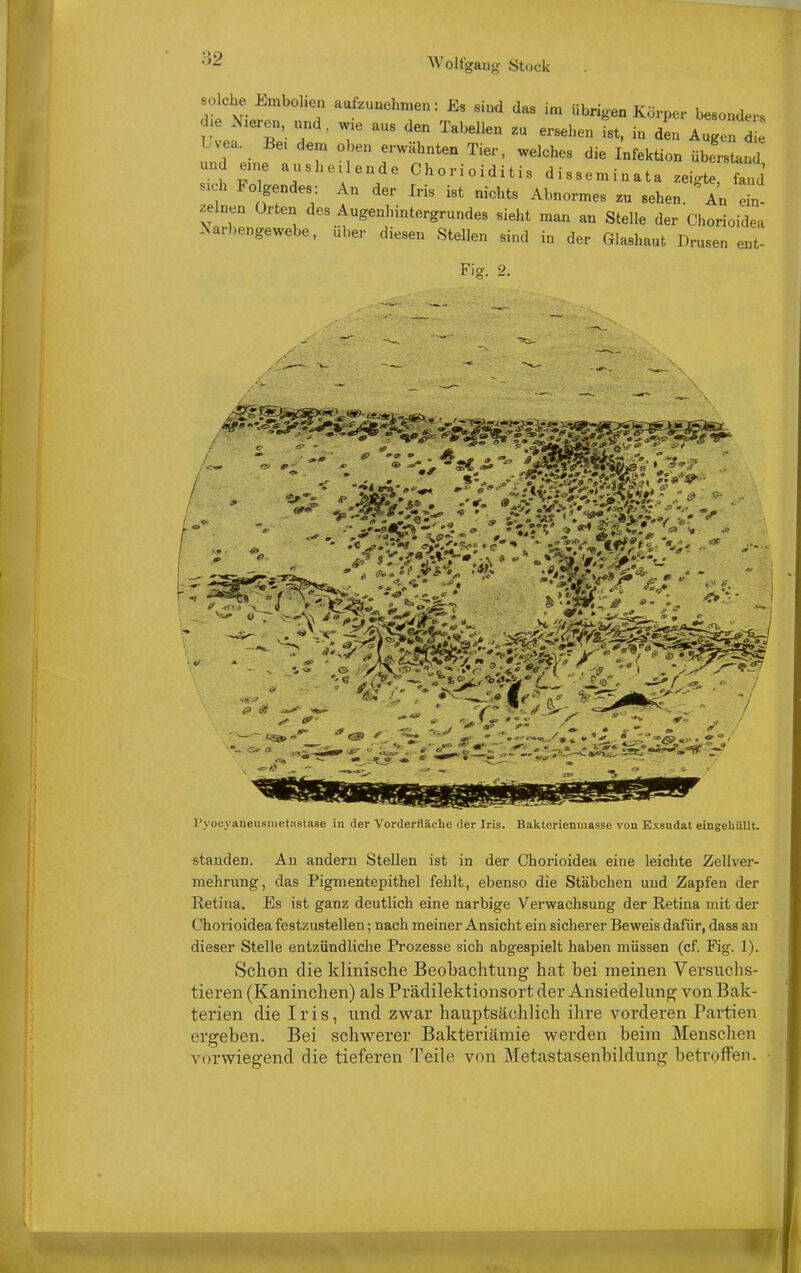 s^che J^mbohen aafzunehn.en: Es sind das übrigen Körper besonders d. Nieren, und, w.e aus den Tabellen zu ersehen ist, in den Augen d Lvea. Bei dem oben erwähnten Tier, welches die Infektion überstand und eane ausheilende Chorioiditis disseminata zeigte, fa d sich Folgendes. An der Iris ist nichts Abnormes zu sehen, 'au ein- zelnen Orten des Augenhintergrundes sieht man an Stelle der Chorioidea .Narbengewebe, über diesen Stellen sind in der Glashaut Drusen ent- Fio-. 2. ]'yoeyaneu.smetii.sta8e in der Vordertläehe der Iris. Bakterienmasse von Exsudat eingeliUllt. standen. An andern Stellen ist in der Chorioidea eine leichte Zellver- mehrung, das Pigmentepithel fehlt, ebenso die Stäbchen und Zapfen der Retina. Es ist ganz deutlich eine narbige Verwachsung der Retina mit der Chorioidea festzustellen; nach meiner Ansicht ein sicherer Beweis dafür, dass an dieser Stelle entzündliche Prozesse sich abgespielt haben müssen (cf. Fig. 1). Schon die klinische Beobachtung hat bei meinen Versuclis- tieren (Kaninchen) als Prädilektionsort der Ansiedelung von Bak- terien die Iris, und zwar hauptsächlich ihre vorderen Partien ergeben. Bei schwerer Bakteriämie werden beim Menschen vorwiegend die tieferen Teile von Metastasenbildung betroffen.