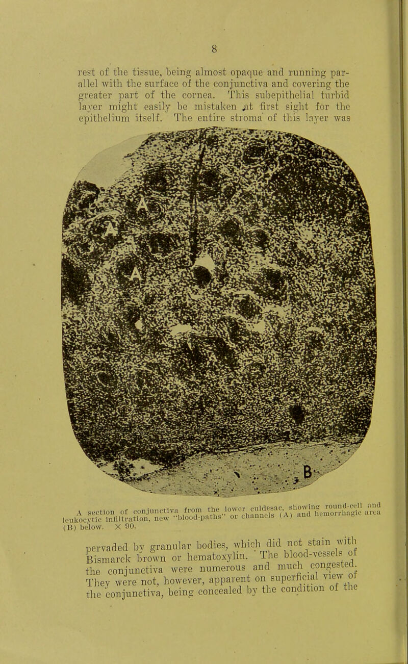 rest of the tissue, being almost opaque and running par- allel with the surface of the conjunctiva and covering the greater part of the cornea. This subepithelial turbid layer might easilj' be mistaken ^t first sight for the epithelium itself. The entire stroma' of this layer was Iciikocy (B) below X 00. pervaded by granular bodies, which did not stain with Earck broln or hematoxylin. The blood-ve.sels of the conjunctiva were numerous and much congested^ They were not, however, apparent on superficial view oi the conjunctiv;, being concealed by the condition ot the