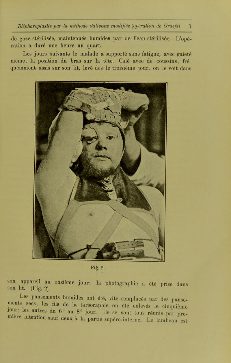 de gaze störilisöe, maintenuös humides par de l'eau st6rilis6e. L'op6- ration a dur6 une heure un quart. Les jours suivants le malade a Supporte sans fatigue, avec gaiete meme, la position du bras sur la tete. Cal6 avec de coussins, fr6- quemment assis sur son lit, lev6 des le troisieme jour, on le voit dans Fig. 2. son appareil au onzieme jour: la Photographie a ete prise dans son lit. (Fig. 2). Les pansements humides ont ete, vite remplaces par des panse- ments secs, les fils de la tarsoraphie ou ete euleves le ciuquieme jour: les autres du 6« au 8 jour. Iis se sont tous reunis par pre- miere mtentton sauf deux ä la partie supero-iuterne. Le lambeau est