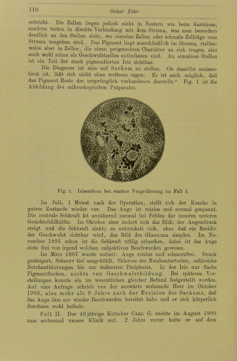 entsteht. Die Zellen liegen jedoch nicht in Nestern wie beim Karzinom, sondern treten in direkte Verbindung mit dem Stroma, was man besonders deutlich an den Stellen sieht, wo einzelne Zellen oder schmale Zellzüge vom Stroma umgeben sind. Das Pigment liegt ausschließlich im Stroma, stellen- weise aber in Zellen, die einen progressiven Charakter an sich tragen, also auch wohl schon als Geschwulstzellen aufzufassen sind. An einzelnen Stellen ist ein Teil der stark pigmentierten Iris sichtbar. Die Diagnose ist also auf Sarkom zu stellen. Ob dasselbe melano- tisch ist, läßt sich nicht ohne weiteres sagen. Es ist auch möglich, daß das Pigment Reste des ursprünglich vorhandenen darstellt. Fig. 1 ist die Abbildung des mikroskopischen Präparates. Fig. 1. Irissarkoni bei starker Vergrößerung im Fall I. Im Juli, 1 Monat nach der Operation, stellt sich der Kranke in gutem Zustande wieder vor. Das Auge ist reizlos und normal gespannt. Die zentrale Sehkraft ist annähernd normal bei Fehlen der inneren unteren Gesichtsfeldhälfte. Im Oktober aber ändert sich das Bild: der Augendruck steigt und die Sehkraft sinkt; es entwickelt sich, ohne daß ein Rezidiv der Geschwulst sichtbar wird, das Bild des Glaucoma simplex. Im No- vember 1895 schon ist die Sehkraft völlig erloschen, dabei ist das Auge stets frei von irgend welchen subjektiven Beschwerden gewesen. Im März 1897 wurde notiert: Auge reizlos und schmerzfrei. Druck gesteigert, Sehnerv tief ausgehöhlt, Sklerose der Netzhautarterien, zahlreiche Netzhautblutungen bis zur äußersten Peripherie. In der Iris nur flache Pigmentflocken, nichts von Geschwulstbildung. Bei späteren Vor- stellungen konnte ein im wesentlichen gleicher Befund festgestellt worden. Auf eine Anfrage schrieb uns der auswärts wohnende Herr im Oktober 1903, also mehr als 9 Jahre nach der Exzision des Sarkoms, daß das Auge ihm nie wieder Beschwerden bereitet habe und er sich körperlich durchaus wohl befinde. Fall II. Der 43jährige Kutscher Cabl G. suchte im August 1900 zum erstenmal unsere Klinik auf. 2 Jahre zuvor hatte er auf dem