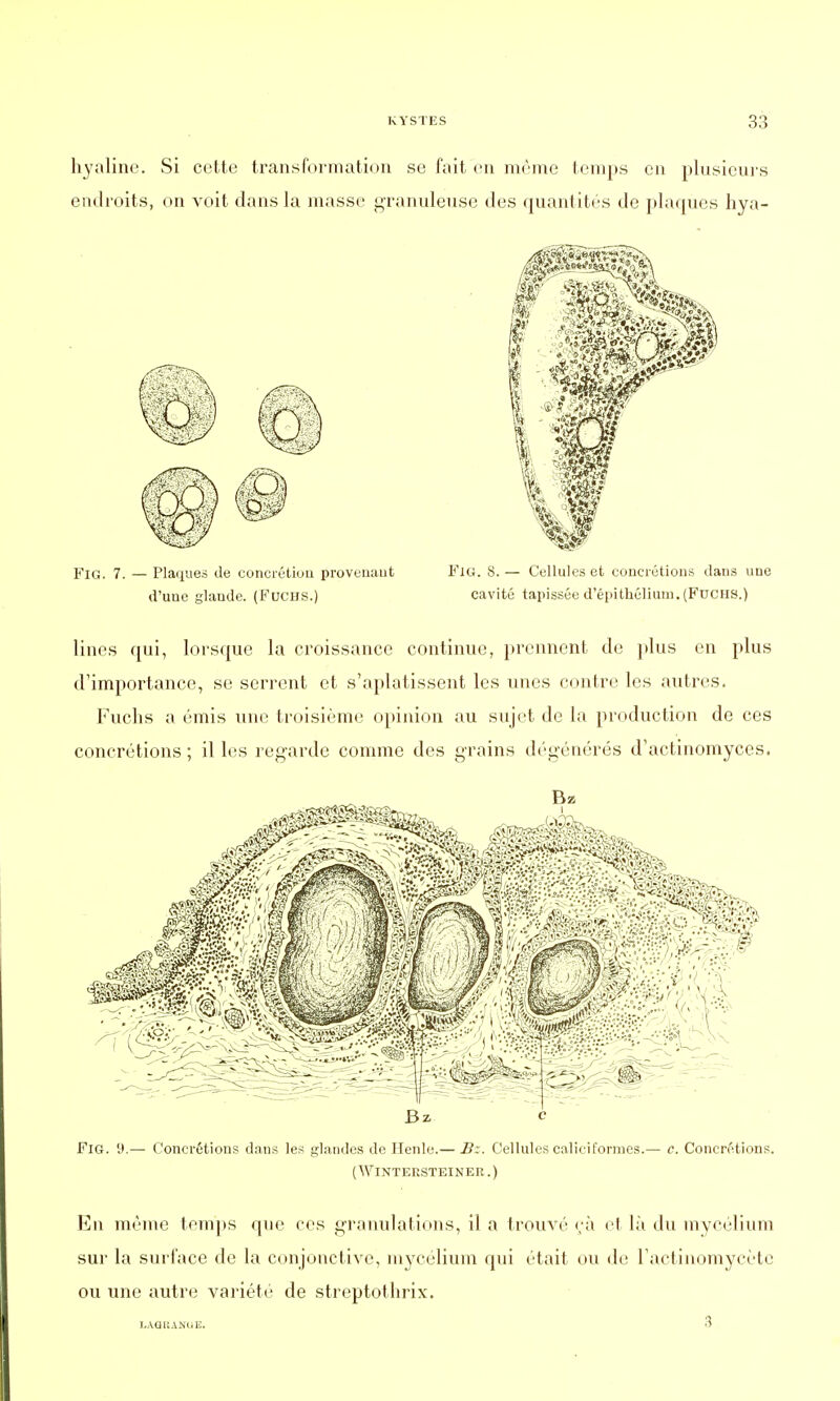 hyaline. Si cette transformation se fait en même temps en plusieurs endroits, on voit dans la masse granuleuse des quantités de plaques hya- FlG. 7. — Plaques de concrétion provenant FiG. S.— Cellules et concrétions dans une d'une glande. (FuCHS.) cavité tapissée d'épithéliuiu.(FuCHS.) lines qui, lorsque la croissance continue, prennent de plus en plus d'importance, se serrent et s'aplatissent les unes contre les autres. Fuchs a émis une troisième opinion au sujet de la production de ces concrétions ; il les regarde comme des grains dégénérés d'actinomyces. (WlNTEBSTEINER.) En même temps que ces granulations, il a trouvé <;à et là du mycélium sur la surface de la conjonctive, mycélium qui était ou de l'actinomycète ou une autre variété de streptothrix. J.AQItANUE. 3