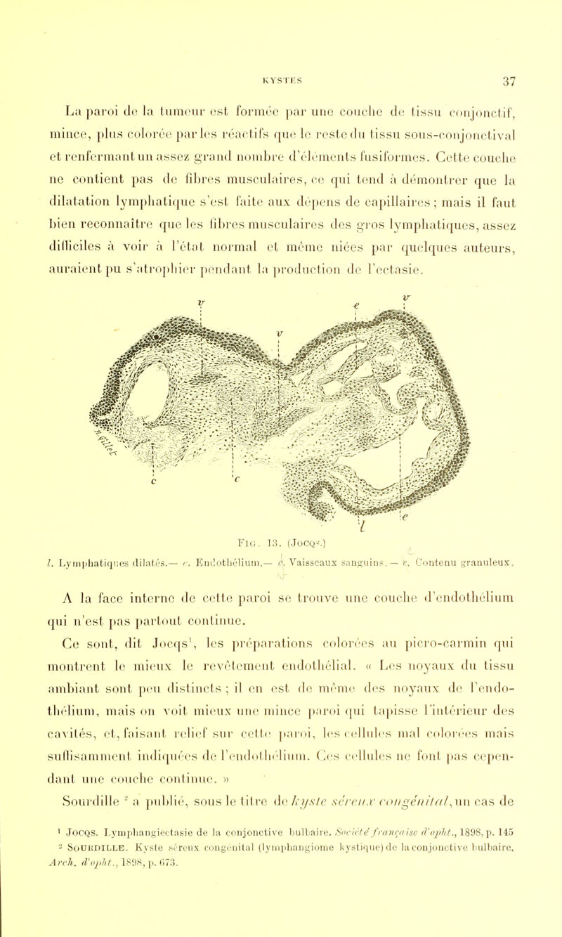 La paroi du la tumeur est formée par une couche de tissu conjonctif, mince, plus colorée parles réactifs que le reste du tissu sous-conjonctival et renfermant un assez grand nombre d'éléments fusiformes. Cette couche ne contient pas de fibres musculaires, ce qui tend à démontrer que la dilatation lymphatique s'est faite aux dépens de capillaires ; mais il faut bien reconnaître que les libres musculaires des gros lymphatiques, assez difficiles à voir à l'état normal et même niées par quelques auteurs, auraient pu s'atrophier pendant la production de l'ectasie. FlG. 13. (Jocq-<.) /. Lymphatiques dilatés.— e. Kndotbêïium.— a. Vaisseaux sanguins. — v. Contenu granuleux. A la face interne de cette paroi se trouve une couche d'endothélium qui n'est pas partout continue. Ce sont, dit Jocqs1, les préparations colorées au picro-carmin qui montrent le mieux le revêtement endothélial. « Les noyaux du tissu ambiant sont peu distincts ; il en est de même des noyaux de l'endo- thélium, mais on voit mieux une mince paroi qui tapisse l'intérieur des cavités, et, faisant relief sur cette paroi, les cellules mal colorées mais suffisamment indiquées de l'endothélium. Ces cellules ne font pas cepen- dant une couche continue. » Sourdille 2 a publié, sous le titre de kyste séreux conge'fiital,xm cas de 1 Jocqs. Lymphangiectasie de la conjonctive bulbaire. Société française d'opht., 1898, p. 145 2 Soukdille. Kyste séreux congénital (lymphangionie kystique) de la conjonctive bulbaire. Arch. d'oplit., 189S,p. HT:?.