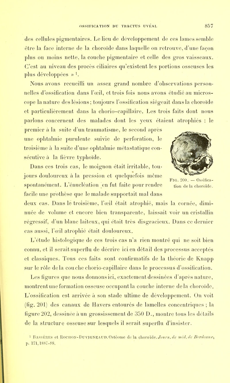 des cellules pigmentaires. Le lieu de développement de ces lames semble être la face interne de la choroïde dans laquelle on retrouve, d'une façon plus ou moins nette, la couche pigmentaire et celle des gros vaisseaux. C'est au niveau des procès ciliaires qu'existent les portions osseuses les plus développées » '. Nous avons recueilli un assez grand nombre d'observations person- nelles d'ossification dans l'œil, et trois fois nous avons étudié au micros- cope la nature des lésions; toujours l'ossification siégeait dans la choroïde et particulièrement dans la chorio-capillaire. Les trois faits dont nous parlons concernent des malades dont les yeux étaient atrophiés : le premier à la suite d'un traumatisme, le second après une ophtalmie purulente suivie de perforation, le troisième à la suite d'une ophtalmie métastatique con- sécutive à la fièvre typhoïde. Dans ces trois cas, le moignon était irritable, tou- jours douloureux à la pression et quelquefois même J . FlG- 200• — Ossifica- spontanément. L'énucléation en fut faite pour rendre tion delà choroïde. facile une prothèse que le malade supportait mal dans deux cas. Dans le troisième, l'œil était atrophié, mais la cornée, dimi- nuée de volume et encore bien transparente, laissait voir un cristallin régressif, d'un blanc laiteux, qui était très disgracieux. Dans ce dernier cas aussi, l'œil atrophié était douloureux. L'étude histologique de ces trois cas n'a rien montré qui ne soit bien connu, et il serait superflu de décrire ici en détail des processus acceptés et classiques. Tous ces faits sont conlirmatifs de la théorie de Knapp sur le rôle delà couche chorio-capillaire dans le processus d'ossification. Les figures que nous donnons ici, exactement dessinées d'après nature, montrent une formation osseuse occupant la couche interne delà choroïde. L'ossification est arrivée à son stade ultime de développement. Un voit (fig. 201) des canaux de H avers entourés de lamelles concentriques ; la ligure 202, dessinée à un grossissement de 350 D., montre tous les détails de la structure osseuse sur lesquels il serait superflu d'insister. 1 r.AssÈREs et Rociiox-Duvigneaud. Ostéome du la choroïde. Jovrn. de mcd.de Bordeaux, p. 171,1887-88.