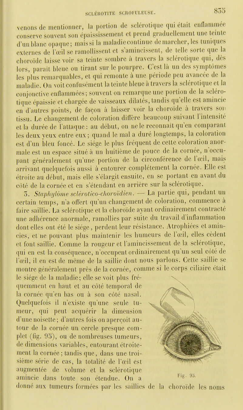 85 0 venons de mcnlionnci-, la portion de scléroliquc qui était ennaniniee conserve souvent son épaississenienl et prend graduellement une teinte d'un blanc opaque; niaissi la nialadiecontiiuuî deniai-elier, les tuniques externes de TolmI se ranu)llissent et s'amincissent, de telle sorte que la choroïde laisse voir sa teinte sondjre à travers la sclérotique qui, dès lors, parait bleue ou tirant sur le pourpre. C'est là un des symptômes les plus remarciuables, et qui remonte à une période jicu avancée de la maladie. On voit confusément la teinte bleue à travers la sclérotique et la conjonctive enllammécs; souvent on remarque une i)orlion de la scléro- tique épaissie et chargée de vaisseaux dilatés, tandis <iu'cllc est amincie en d'autres points, de façon à laisser voir la choroïde à travers son tissu. Le changement de coloration difl'ère beaucoup suivant l'intensité et la durée de l'attaque: au début, ou ne le reconnaît qu'en comparant les deux yeux entre eux ; quand le mal a duré longtemps, la coloration est d'un bleu foncé. Le siège le plus fréquent de cette coloration anor- male est un espace situé à un huitième de pouce de la cornée, n'occu- pant généralement qu'une portion de la circonférence de l'œil, mais arrivant quelquefois aussi à entourer complètement la cornée. Elle est étroite au début, mais elle s'élargit ensuite, en se portant eu avant du côté de la cornée et en s'élendant en arrière sur la sclérotique. 5. Skiphylôme sclérotico<horoïclien. — La partie qui, pendant un certain temps, n'a olTert qu'un changement de coloration, commence à faire saillie. La sclérotique et la choroïde ayant ordinairement contracté une adhérence anormale, ramollies par suite du travail d'inflammation dont elles ont été le siège, perdent leur résistance. Atrophiées et amin- cies, et ne pouvant plus maintenir les humeurs de l'œil, elles cèdent et font saillie. Comme la rougeur et l'amincissement de la sclérotique, qui en est la conséquence, n'occupent ordinairement qu'un seul côté de l'œil, il en est de même de la saillie dont nous parlons. Celte saillie se montre généralement près de la cornée, comme si le corps ciliaire était le siège de la maladie; elle se voit plus fré- quemment en haut et au côté temporal de la cornée qu'en bas ou à son côté nasal. Quelquefois il n'existe qu'une seule tu- meur, qui peut acquérir la dimension d'une noisette; d'autres fois on aperçoit au- tour de la cornée un cercle presque com- plet (Og. do), ou de nombreuses tumeurs, de dimensions variables, entourant étroite- ment la cornée ; tandis que, dans une troi- sième série de cas, la totalité de l'œil est augmentée de volume et la scléroli(jue amincie dans toute son étendue. On a '''S' donné aux tumeurs formées par les saillies de la choroïde les noms