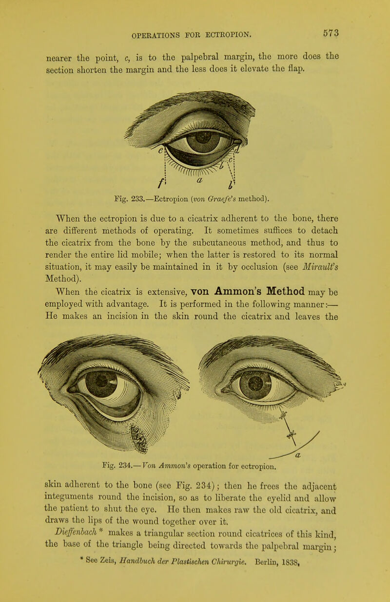 nearer the point, c, is to the palpebral margin, the more does the section shorten the margin and the less does it elevate the flap. Fig. 233.—Ectropion {von Graefe's method). When the ectropion is due to a cicatrix adherent to the bone, there are different methods of operating. It sometimes suffices to detach the cicatrix from the bone by the subcutaneous method, and thus to render the entire lid mobile; when the latter is restored to its normal situation, it may easily be maintained in it by occlusion (see MirauU's Method). When the cicatrix is extensive, VOn Ammon's Method may be employed with advantage. It is performed in the following manner:— He makes an incision in the skin round the cicatrix and leaves the skin adherent to the bone (see Fig. 234); then he frees the adjacent integuments round the incision, so as to liberate the eyelid and allow the patient to shut the eye. He then makes raw the old cicatrix, and draws the lips of the wound together over it. Dieffenbach * makes a triangular section round cicatrices of this kind, the base of the triangle being directed towards the palpebral margin; * See Zeis, Handbuch der PlastiscJien Ghirurgie. Berlin, 1838,
