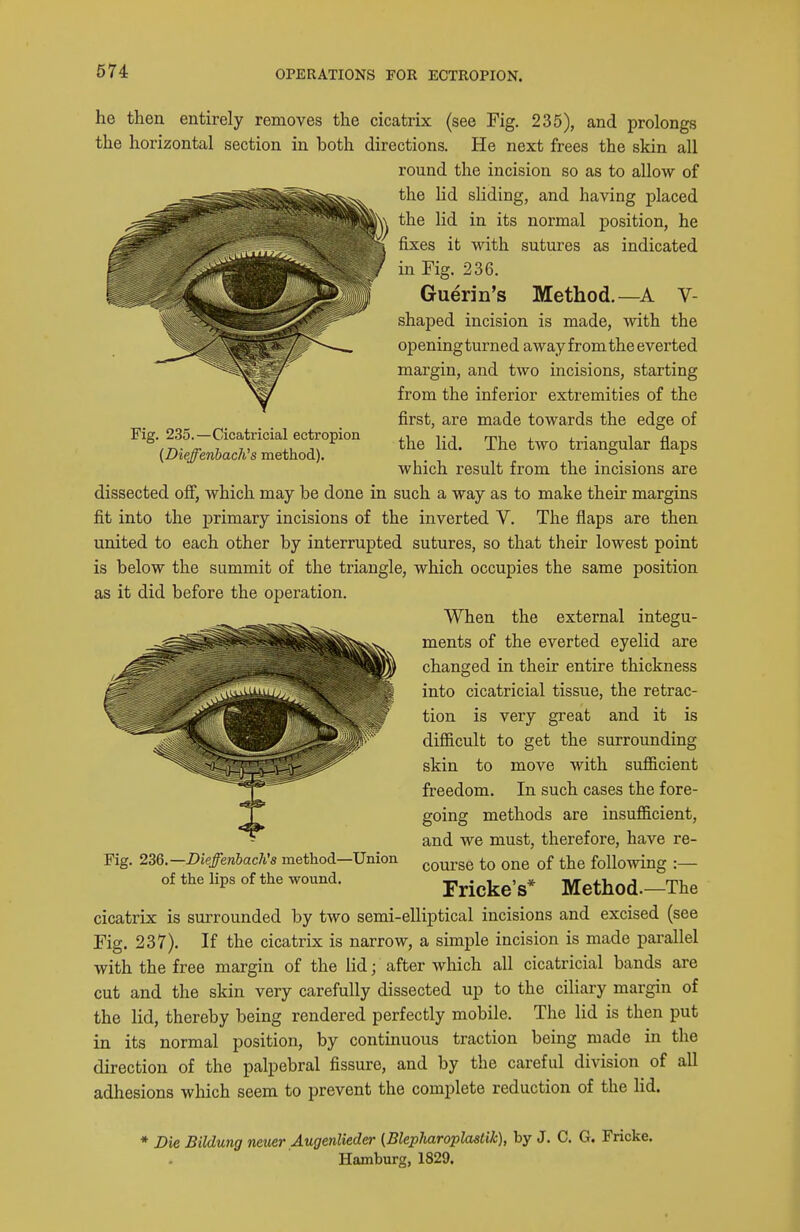 Fig. 235.—Cicatricial ectropion {DieffenhacKs method). he then entirely removes the cicatrix (see Fig. 235), and prolongs the horizontal section in both directions. He next frees the skin all round the incision so as to allow of the lid sliding, and having placed the lid in its normal position, he fixes it with sutures as indicated in Fig. 236. Guerin's Method.—A V- shaped incision is made, with the opening turned away from the everted margin, and two incisions, starting from the inferior extremities of the first, are made towards the edge of the lid. The two triangular flaps which result from the incisions are dissected off, which may be done in such a way as to make their margins fit into the primary incisions of the inverted V. The flaps are then united to each other by interrupted sutures, so that their lowest point is below the summit of the triangle, which occupies the same position as it did before the operation. When the external integu- ments of the everted eyelid are changed in their entire thickness into cicatricial tissue, the retrac- tion is very great and it is difficult to get the surrounding skin to move with sufficient freedom. In such cases the fore- going methods are insufficient, and we must, therefore, have re- course to one of the following :— Fricke's* Method.—The cicatrix is surrounded by two semi-elliptical incisions and excised (see Fig. 237). If the cicatrix is narrow, a simple incision is made parallel with the free margin of the lid; after wlaich all cicatricial bands are cut and the skin very carefully dissected up to the ciliary margin of the lid, thereby being rendered perfectly mobile. The lid is then put in its normal position, by continuous traction being made in the direction of the palpebral fissure, and by the careful division of all adhesions which seem to prevent the complete reduction of the lid. Fig. 2iQ.—DieffenhacKs method—Union of the lips of the wound. * Die Bildung newr Augenlieder (BlepJiaroplaslik), by J. C. G. Fricke. Hamburg, 1829.