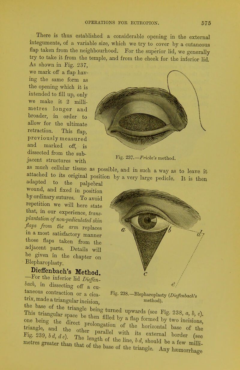 There is thus established a considerable oi^ening in the external integuments, of a variable size, which we try to cover by a cutaneous flap taken from the neighbourhood. For the superior lid, we generally try to take it from the temple, and from the cheek for the inferior lid. As shown in Fig. 237, we mark off a flap hav- ing the same form as the opening which it is intended to fill up, only we make it 2 milli- metres longer and broader, in order to allow for the ultimate retraction. This flap, previously measured and marked off, is dissected from the sub- jacent structures with Fig. 2ZT.—Fricke's method. as much ceUular tissue as possible, and in such a way as to leave it attached to its original position by a very large pedicle. It is then adapted to the palpebral wound, and fixed in position by ordinary sutures. To avoid repetition we will here state that, in our experience, trans- plantation of non-pedkulated skin flaps from the arm replaces in a most satisfactory manner those flaps taken from the adjacent parts. Details will be given in the chapter on Blei^haroplasty. Dieflfenbach's Method. —For the inferior lid Diejfen- iach, in dissecting off a cu- taneous contraction or a cica- trix, made a triangular incision ?hl'ianL?' 'f' ^^ '^^^^ Fig. 238 a I c) triangle,'and th ZtT t/'/''^^ ''''' metres greater than that tt bal ? P. ' i' nac ot the base of the triangle. Any ha^morrha: Pig. 238.—Blepharoplasty {Diefcnhach's method). lage