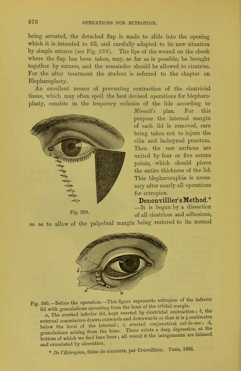 being arrested, the detached flap is made to slide into the opening which it is intended to fill, and carefully adapted to its new situation by simple sutures (see Fig. 239). The lips of the wound on the cheek where the flap has been taken, may, as far as is possible, be brought together by sutures, and the remainder should be allowed to cicatrise. For the after treatment the student is referred to the chapter on Blepharoplasty. An excellent means of preventing contraction of the cicatricial tissue, Avhich may often spoil the best devised operations for blepharo- plasty, consists in the temporary occlusion of the lids according to Miraulfs plan. For this purpose the internal margin of each lid is removed, care being taken not to injure the cilia and lachrymal punctum. Then the raw surfaces are united by four or five suture points, which should pierce the entire thickness of the lid. This blepharoraphia is neces- sary after nearly all operations for ectropion. Denonvillier's Method.* —It is begun by a dissection of all cicatrices and adhesions, so as to aUow of the palpebral margin being restored to its normal Fig 240.-Before the operation.-This figure represents ectropion of the inferior Ud with granulations sprouting from the bone of the orbital margin. a The everted inferior lid. kept everted by cicatricial contraction; 6, the external commissure drawn outwards and downwards so that it - 4 -ntime^^^ below the level of the internal; c, everted conjunctival ^ul-de-sac, ^, granulations arising from the bone. There exists a deep '^-P--;°> bottom of which we find bare bone; all round it the integuments are thinned and excoriated by ulceration. • 2?e I'Ectropion, thbse de concours, par Cruveilhier. Paris, 1866.