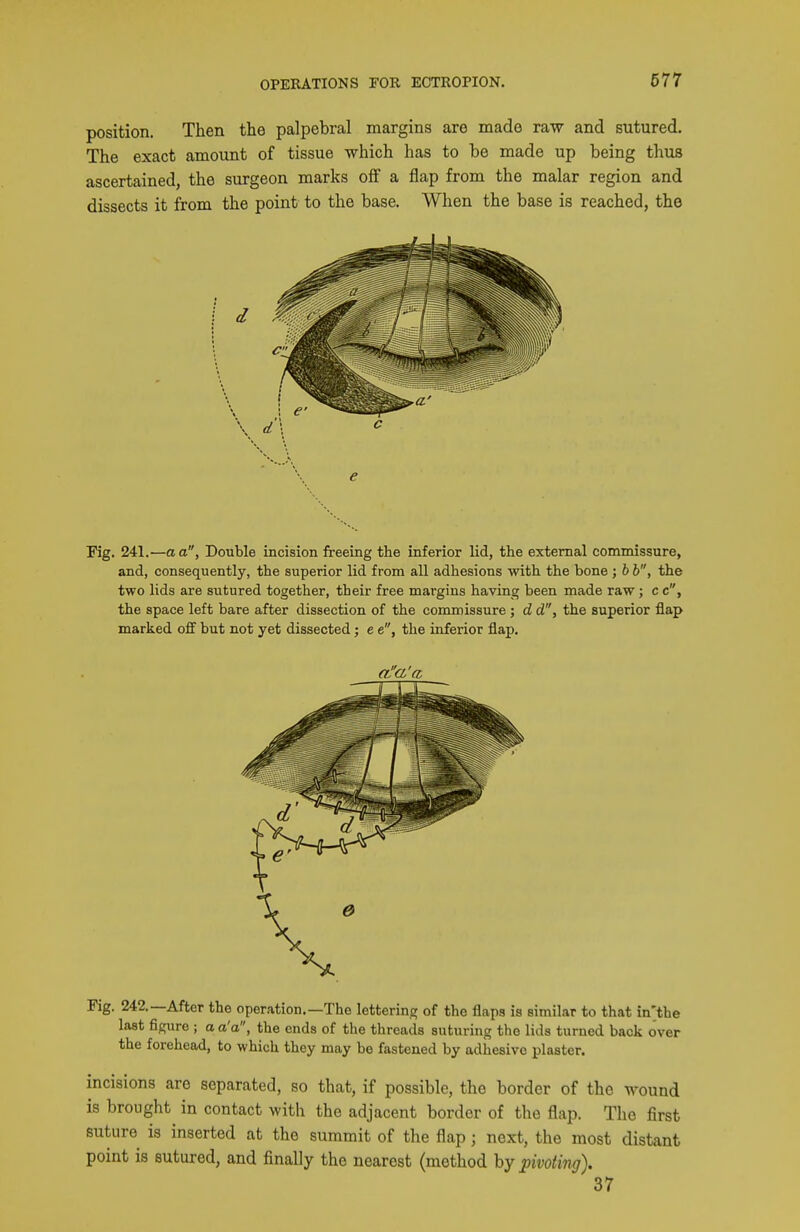 position. Then the palpebral margins are made raw and sutured. The exact amoimt of tissue which has to be made up being thus ascertained, the surgeon marks off a flap from the malar region and dissects it from the point to the base. When the base is reached, the e Fig. 241.—a a, Double incision freeing the inferior lid, the external commissure, and, consequently, the superior lid from all adhesions with the bone ; h b, the two lids are sutured together, their free margins having been made raw ; c c, the space left bare after dissection of the commissure ; d d, the superior flap marked off but not yet dissected; e e, the inferior flap. Fig. 242.—After the operation.—The lettering of the flaps is similar to that in'the last figure ; a a'a, the ends of the threads suturing the lids turned back over the forehead, to which they may be fastened by adhesive plaster. incisions are separated, so that, if possible, the border of the wound is brought in contact with the adjacent border of the flap. The first suture is inserted at the summit of the flap; next, the most distant point is sutured, and finally the nearest (method by pivoting). 37