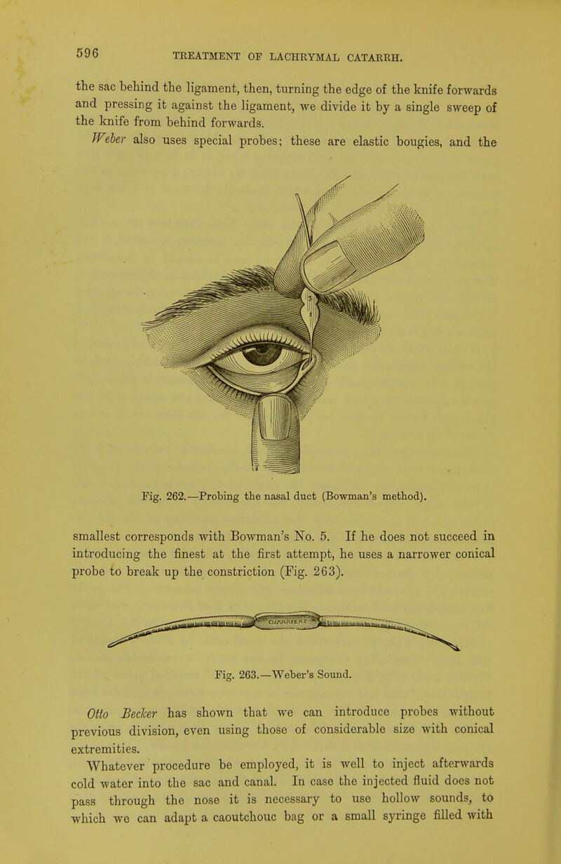 the sac behind the ligament, then, turning the edge of the knife forwards and pressing it against the ligament, we divide it by a single sweep of the knife from behind forwards. Weber also uses special probes; these are elastic bougies, and the Fig. 262.—Probing the nasal duct (Bowman's method). smallest corresponds with Bowman's No. 5. If he does not succeed in introducing the finest at the first attempt, he uses a narrower conical probe to break up the constriction (Fig. 263). Fig, 263.—Weber's Sound. Otto Becker has shown that we can introduce probes without previous division, even using those of considerable size with conical extremities. Whatever procedure be employed, it is well to inject afterwards cold water into the sac and canal. In case the injected fluid does not pass through the nose it is necessary to use hollow sounds, to which we can adapt a caoutchouc bag or a small syringe filled with