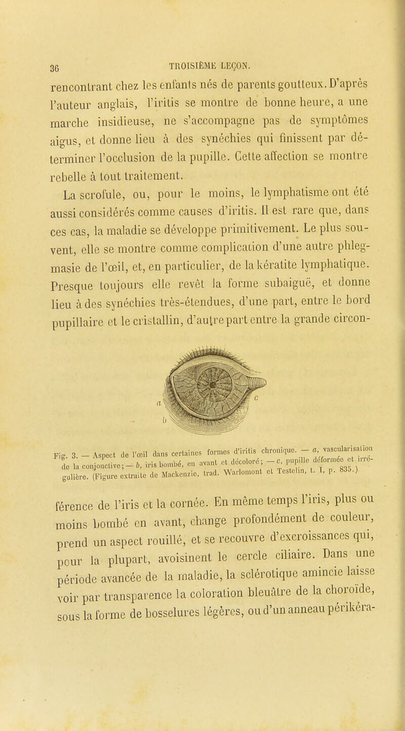 rencontrant chez les enfants nés de parents goutteux. D'après l'auteur anglais, l'iritis se montre de bonne heure, a une marche insidieuse, ne s'accompagne pas de symptômes aigus, et donne lieu à des synéchies qui finissent par dé- terminer l'occlusion de la pupille. Cette affection se montre rebelle à tout traitement. La scrofule, ou, pour le moins, le lymphatisme ont été aussi considérés comme causes d'iritis. il est rare que, dans ces cas, la maladie se développe primitivement. Le plus sou- vent, elle se montre comme complication d'une autre phleg- masie de l'œil, et, en particulier, de la kératite lymphatique. Presque toujours elle revêt la forme subaiguë, et donne lieu à des synéchies très-étendues, d'une part, entre le bord pupillaire et le cristallin, d'autre part entre la grande circon- Pig. 3. - Aspect de l'œil dans certaines formes d'irita. cbron.que. - 10« L laconjolve;-!,, iris bombé, en avant et décoloré; ...mUe déforme t ue- gulière. (Figure extraite de Mackcnzie, trad. Warlomont et Testel.n, t. I, p. 83».) férence de l'iris et la cornée. En même temps l'iris, plus ou moins bombé en avant, change profondément de couleur, prend un aspect rouillé, et se recouvre d'excroissances qui, pour la plupart, avoisinent le cercle ciliaire. Dans une période avancée de la maladie, la sclérotique amincie laisse voir par transparence la coloration bleuâtre de la choroïde, sous la forme de bosselures légères, ou d'un anneau périkera-