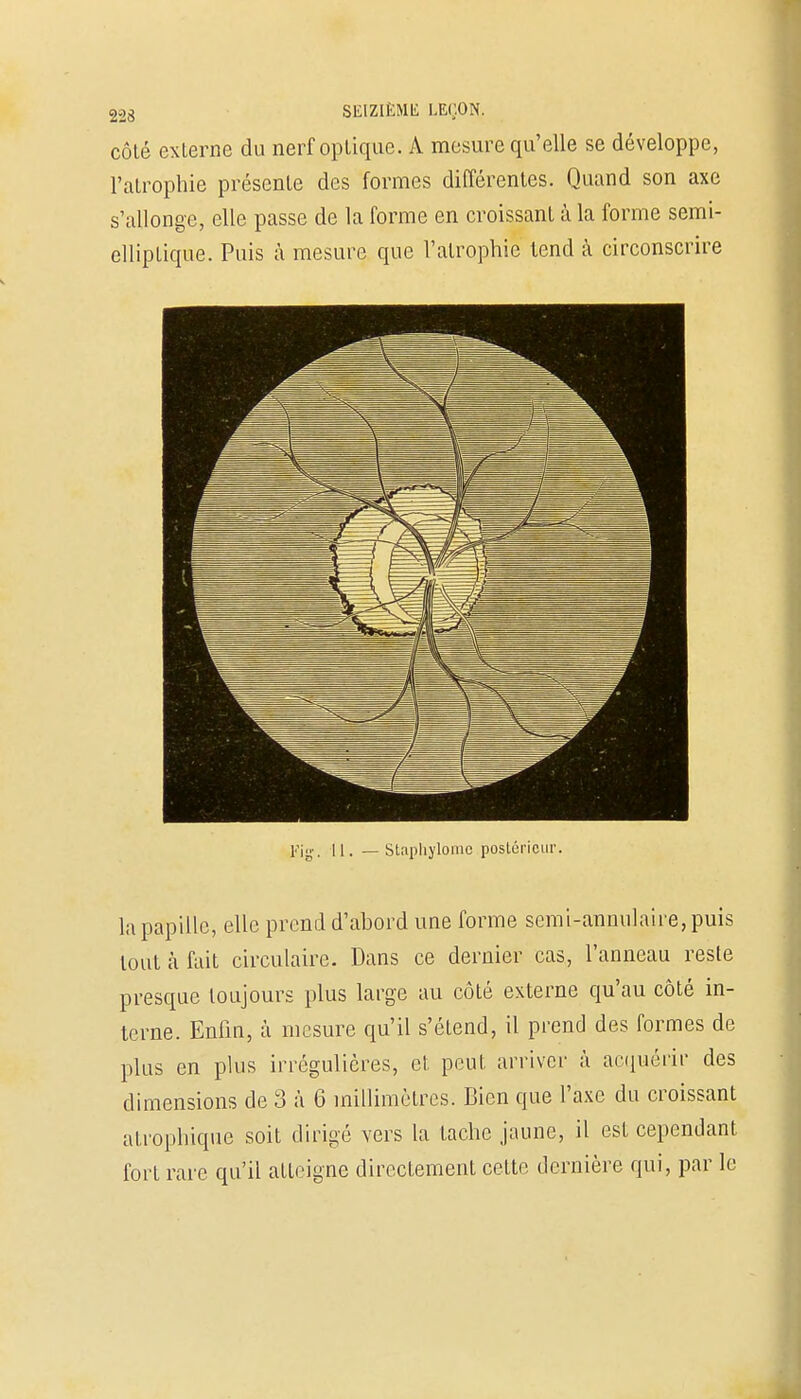 côté externe du nerf optique. À mesure qu'elle se développe, l'atrophie présente des formes différentes. Quand son axe s'allonge, elle passe de la forme en croissant à la forme semi- elliptique. Puis à mesure que l'atrophie tend à circonscrire Piff. u. Staphylomo posté rieur. la papille, elle prend d'abord une forme semi-annulaire, puis tout à fait circulaire. Dans ce dernier cas, l'anneau reste presque toujours plus large au côté externe qu'au côté in- terne. Enfin, à mesure qu'il s'étend, il prend des formes de plus en plus irrégulières, et peut arriver à acquérir des dimensions de 3 à 6 millimètres. Bien que l'axe du croissant atrophique soit dirigé vers la tache jaune, il est cependant fort rare qu'il atteigne directement cette dernière qui, par le