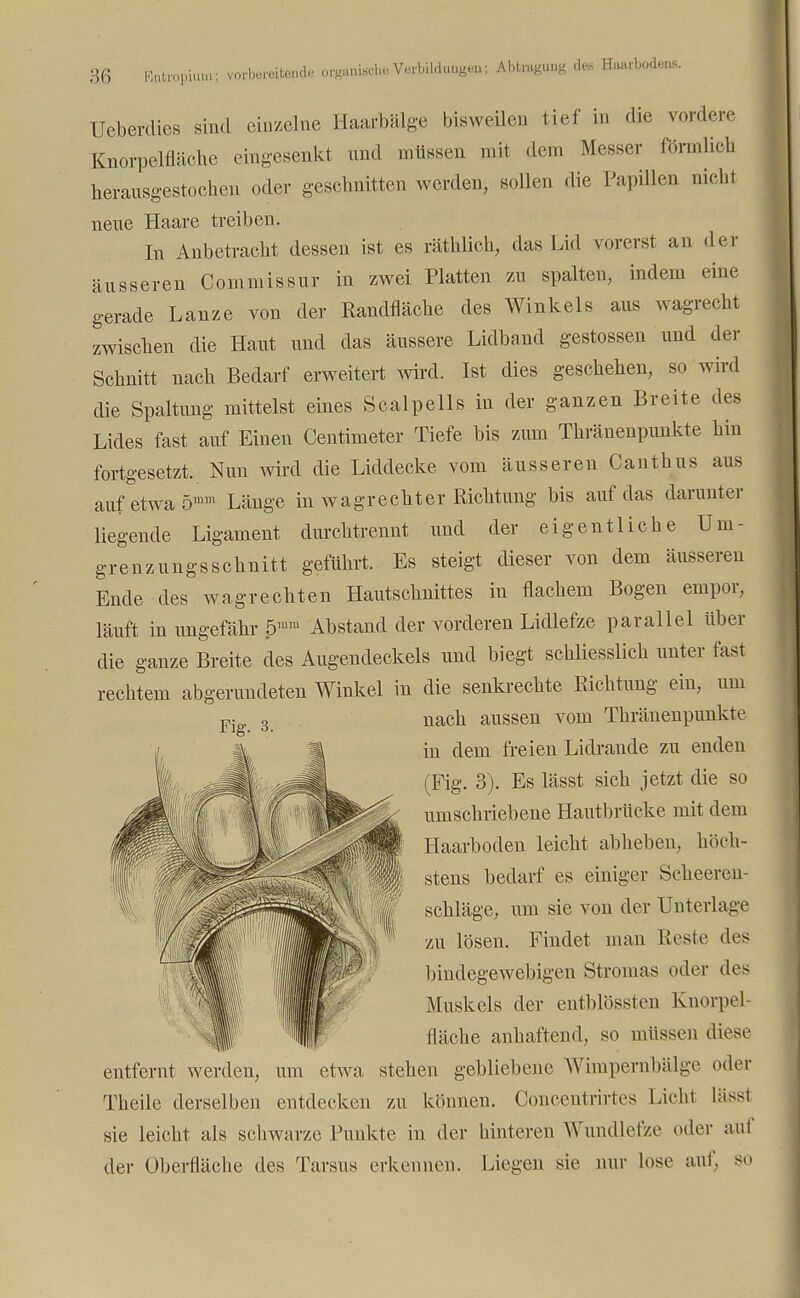 8:0 Kntropium: vorbereitend« oW«»isel,, Verlnlduuge«; AbtiugiuiK des Haarbodens. Ueberdies sind einzelne Haarbälge bisweileD tief in die vordere Knorpelfläche eingesenkt und müssen mit dem Messer förmlich herausgestochen oder geschnitten werden, sollen die Papillen niehl neue Haare treiben. In Anbetracht dessen ist es räthlich, das Lid v orerst an der äusseren Commissur in zwei Platten zu spalten, indem eine gerade Lanze von der Randfläche des Winkels aus wagrecht zwischen die Haut und das äussere Lidband gestossen und der Schnitt nach Bedarf erweitert wird. Ist dies geschehen, so wird die Spaltung mittelst eines Scalpells in der ganzen Breite des Lides fast auf Einen Centimeter Tiefe bis zum Thränenpunkte hin fortgesetzt. Nun wird die Liddecke vom äusseren Canthus aus auf etwa 5mm Länge in wagrechter Richtung bis auf das darunter liegende Ligament durchtrennt und der eigentliche Um- grenzungsschnitt geführt. Es steigt dieser von dem äusseren Ende des wagrechten Hautschnittes in flachem Bogen empor, läuft in ungefähr 5ra™ Abstand der vorderen Lidlefze parallel Uber die ganze Breite des Augendeckels und biegt schliesslich unter fast rechtem abgerundeten Winkel in die senkrechte Richtung ein, um Fig. 3. nach aussen vom Thränenpunkte in dem freien Lidrande zu enden (Fig. 3). Es lässt sich jetzt die so umschriebene Hautbrücke mit dein Haarboden leicht abheben, hbeh- ■ stens bedarf es einiger Scheeren- schläge, um sie von der Unterlage zu lösen. Findet man Reste des bindegewebigen Stromas oder des Muskels der entblössten Knorpel fläche anhaftend, so müssen diese entfernt werden, um etwa stehen gebliebene Wimpernbälge oder Theile derselben entdecken zu können. Concentrirtes Lieht liisst sie leicht als schwarze Punkte in der hinteren Wundlefze oder auf der Überfläche des Tarsus erkennen. Liegen sie nur lose auf, so