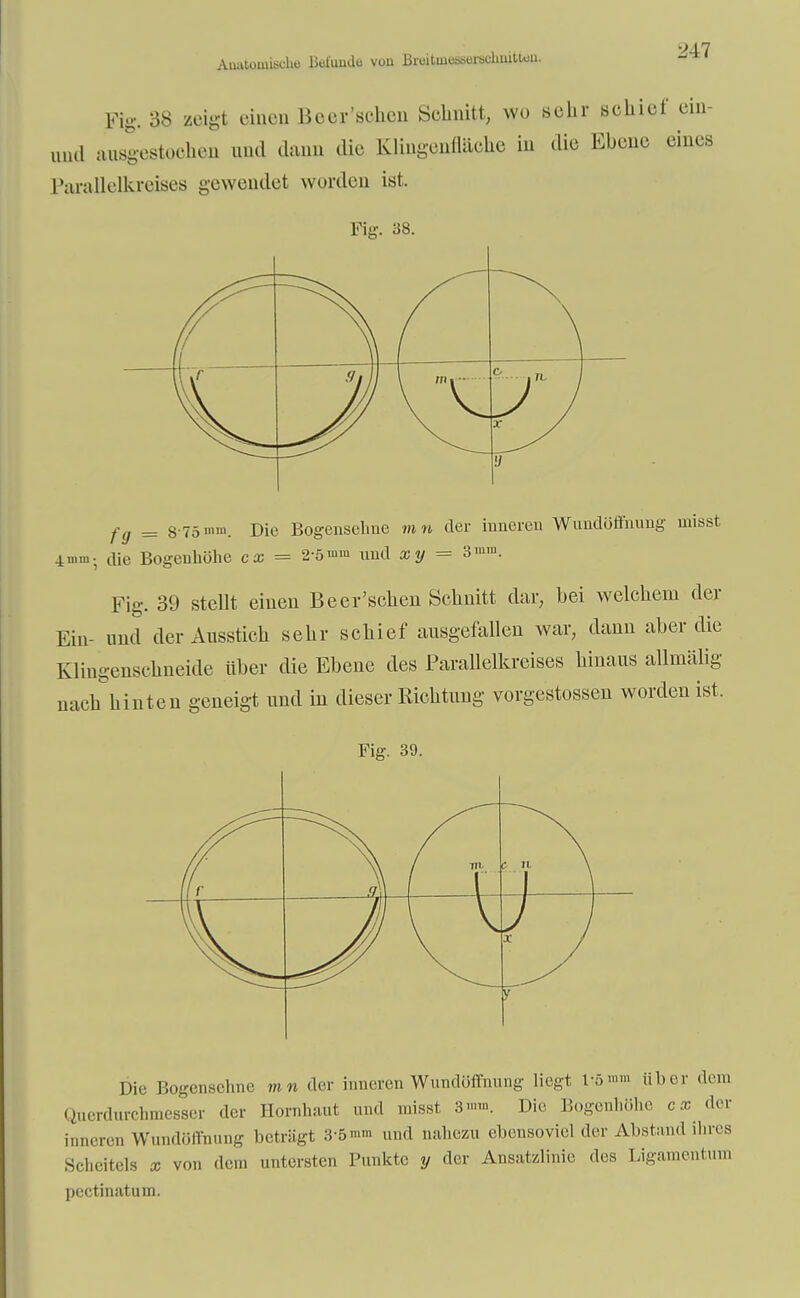 Anatomische Uulumlu vuu KmtwessurscliuiWon. Fig. 38 zeigt einen Beer'schen Schnitt, wo sehr schief ein- mal ausgestochen und dann die Klingennächc in die Ebene eines Parallelkreises gewendet wurden ist. Fig. 38. fg = 8 75'»1. Die Bogensehne mn der inneren Wundöffnung misst 4mm; die Bogeuhöhe cx = 2'5»™ und xy = 3mm- Fig. 39 stellt einen Beer'schen Schnitt dar, bei welchem der Ein- und der Ausstich sehr schief ausgefallen war, dann aber die Klingenschneide über die Ebene des Parallelkreises hinaus allmälig nach hinten geneigt und in dieser Richtung vorgestossen worden ist. Fig. 39. Die Bogensehne mn der inneren Wundöffnung liegt fö»»» über dem Querdurchmesser der Hornhaut und misst 8»». Die Bogenhöhe cx. der inneren Wundöffnung beträgt 3-5'- und nahezu ebensoviel der Abstand ihres Scheitels x von den. untersten Punkte y der Ausatzlinie des Ligamentum pectinatum.