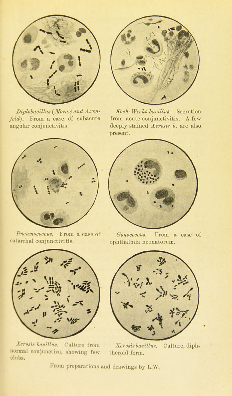 IHplobacillus (Morax and Axen- Koch-Weeks bacillus. Secretion /eld). From a case Of subacute from acute conjunctivitis. A few angular conjunctivitis. deeply stained Xerosis b. are also present. Pneumococcus. From a case of Gonococcus. From a case of catarrhal conjunctivitis. ophthalmia neonatorum. Xe-rori* bacillus. Culture from Xerosis bacillus. Culture, diph- normal conjunctiva, showing few theroid form, clubs. From preparations and drawings by L.W.