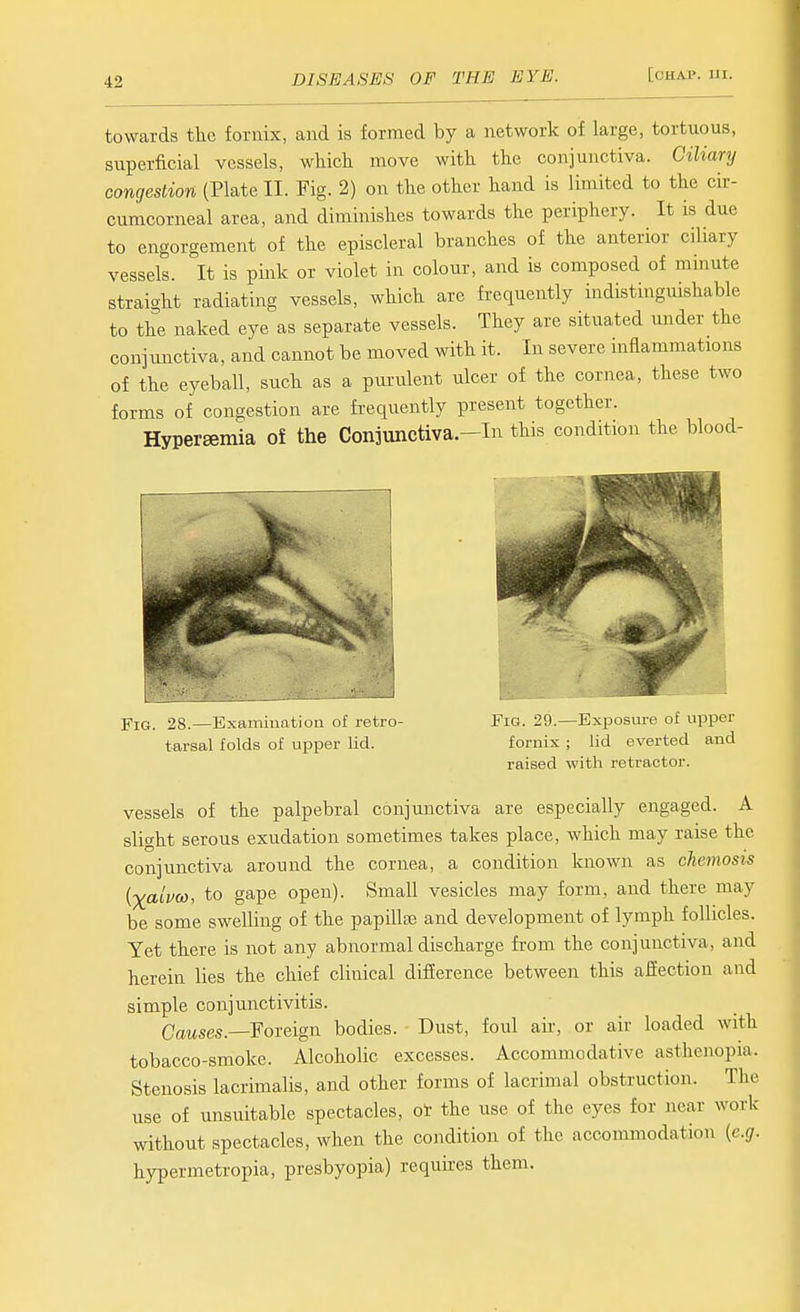 towards tlie fornix, and is formed by a network of large, tortuous, superficial vessels, whicli move witli the conjunctiva. Ciliary congestion (Plate II. Fig. 2) on the other hand is limited to the cir- cumcorneal area, and diminishes towards the periphery. It is due to engorgement of the episcleral branches of the anterior ciliary vessels. It is pink or violet in colour, and is composed of minute straight radiating vessels, which are frequently indistinguishable to the naked eye as separate vessels. They are situated under the conjunctiva, and cannot be moved with it. In severe inflammations of the eyeball, such as a purulent ulcer of the cornea, these two forms of congestion are frequently present together. Hyperemia of the Conjunctiva.-In this condition the blood- Fig. 28.—Kxaniinatiuu of iftro- tarsal folds of upper lid. Fig. 29.—Exposure of upper fornix ; lid everted and raised with retractor. vessels of the palpebral conjunctiva are especially engaged. A slight serous exudation sometimes takes place, which may raise the conjunctiva around the cornea, a condition known as chemosis (■Xaivw, to gape open). Small vesicles may form, and there may be some swelling of the papillfe and development of lymph follicles. Yet there is not any abnormal discharge from the conjunctiva, and herein lies the chief clinical difference between this affection and simple conjunctivitis. CaMses.—Foreign bodies. Dust, foul air, or air loaded with tobacco-smoke. Alcoholic excesses. Accommodative asthenopia. Stenosis lacrimalis, and other forms of lacrimal obstruction. The use of unsuitable spectacles, ot the use of the eyes for near work without spectacles, when the condition of the accommodation {e.g. hypermetropia, presbyopia) requires them.