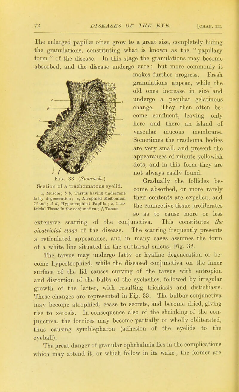 The enlarged papillsc often grow to a great size, completely hiding the granulations, constituting what is known as the  papillary form  of the disease. In this stage the granulations may become absorbed, and the disease undergo cure; but more commonly it makes further progress. Fresh granulations appear, while the old ones increase in size and imdergo a peculiar gelatinous change. They then often be- come confluent, leaviag only here and there an island of vascular mucous membrane. Sometimes the trachoma bodies are very small, and present the appearances of minute yellowish dots, and in this form they are not always easily found. Gradually the follicles be- come absorbed, or more rarely their contents are expelled, and the coimective tissue proliferates so as to cause more or less extensive scarring of the conjunctiva. This constitutes the cicatricial stage of the disease. The scarring frequently presents a reticulated appearance, and in many cases assumes the form of a white line situated in the subtarsal sulcus. Fig. 32. The tarsus may undergo fatty or hyaline degeneration or be- come hypertrophied, while the diseased conjunctiva on the inner surface of the lid causes curving of the tarsus with entropion and distortion of the bulbs of the eyelashes, followed by irregular gTowth of the latter, with resulting trichiasis and distichiasis. These changes are represented in Fig. 33. The bulbar conjunctiva may become atrophied, cease to secrete, aaid become dried, giving rise to xerosis. In consequence also of the shrinking of the con- junctiva, the fornices may become partially or wholly obliterated, thus causing symblepharon (adhesion of the eyelids to the eyeball). The great danger of granular ophthalmia lies in the complications which may attend it, or which follow in its wake; the former are Fig. 33. {Soemisch.) Section of a trachomatous eyelid. a. Muscle; b 6, Tarsus having undergone fatty degeneration; c. Atrophied Meibomian Gland ; d d, Hypertrophied Papilla ; e, Cica- tricial Tissue in the conjunctiva; /, Tarsus.