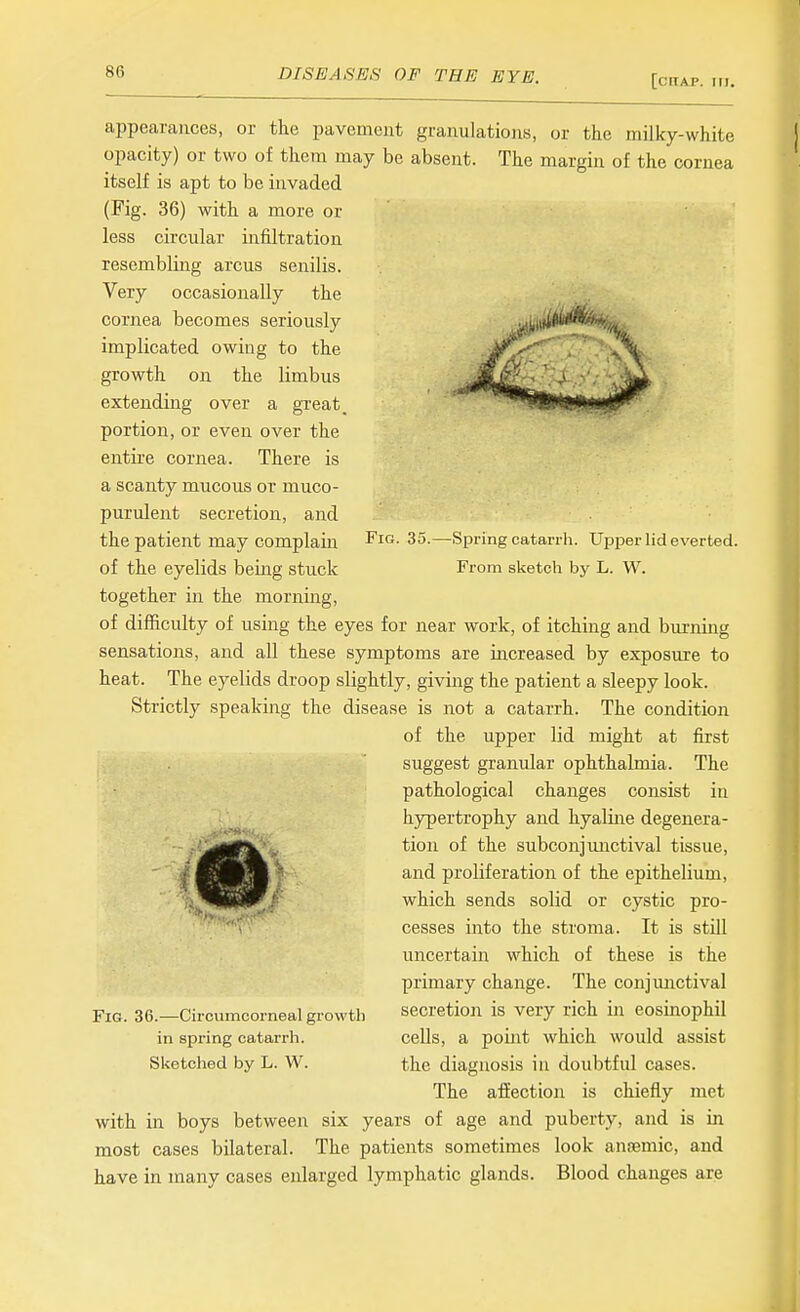 [CrtAP. III. Fig. 35.—Spring catarrh. Upper lid everted. From sketch by L. W. appearances, or the pavement granulations, or the milky-white opacity) or two of them may be absent. The margin of the cornea itself is apt to be invaded (Fig. 36) with a more or less circular infiltration resembling arcus senilis. Very occasionally the cornea becomes seriously implicated owing to the growth on the limbus extending over a gTeat portion, or even over the entire cornea. There is a scanty mucous or muco- purulent secretion, and the patient may complain of the eyelids being stuck together in the morning, of difficulty of using the eyes for near work, of itching and burning sensations, and all these symptoms are increased by exposure to heat. The eyelids droop slightly, giving the patient a sleepy look. Strictly speaking the disease is not a catarrh. The condition of the upper lid might at first suggest granular ophthalmia. The pathological changes consist in hypertrophy and hyaline degenera- tion of the subconjmictival tissue, and proliferation of the epithelium, which sends solid or cystic pro- cesses into the stroma. It is still uncertain which of these is the primary change. The conjimctival secretion is very rich in eosinophil cells, a poiiit which would assist the diagnosis in doubtful cases. The affection is chiefly met with in boys between six years of age and puberty, and is in most cases bilateral. The patients sometimes look anaemic, and have in many cases enlarged lymphatic glands. Blood changes are Fig. 36.—Circumcorneal growth in spring catarrh. Sketched by L. W.