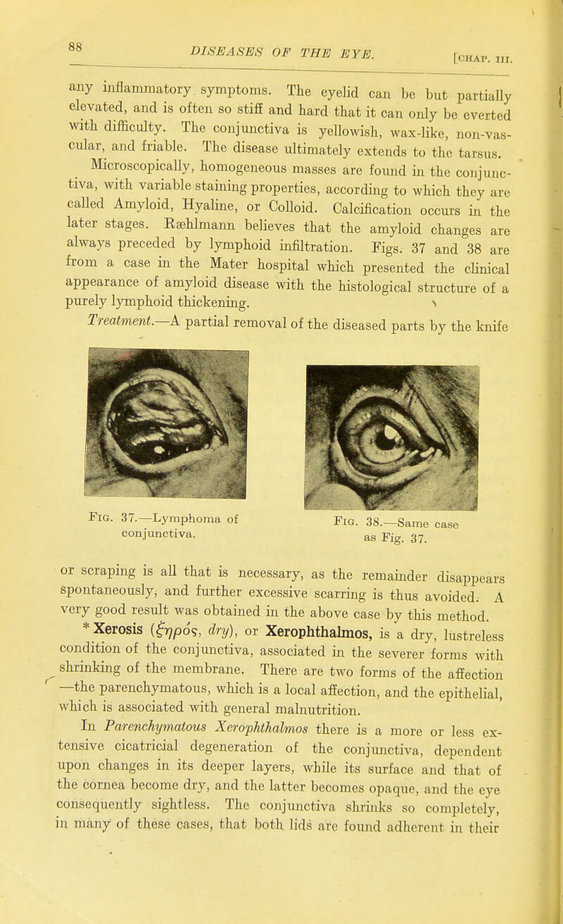 [chap. III. any inflammatory symptoms. The eyelid can be but partially elevated, and is often so stiff and hard that it can only be everted with difficulty. The conjunctiva is yellowish, wax-like, non-vas- cular, and friable. The disease ultimately extends to the tarsus. Microscopically, homogeneous masses are found in the conjunc- tiva, with variable staining properties, according to which they are called Amyloid, Hyaline, or Colloid. Calcification occurs in the later stages. Rsehlmann believes that the amyloid changes are always preceded by lymphoid infiltration. Figs. 37 and 38 are from a case in the Mater hospital which presented the cUnical appearance of amyloid disease with the histological structure of a purely Ijmiphoid thickening. n Treatment.—k partial removal of the diseased parts by the knife Fig. 37.—Lyjuphoma of conjunctiva. Fig. 38.—Same case as Fig. 37. or scraping is all that is necessary, as the remainder disappears spontaneously, and further excessive scarring is thus avoided. A very good result was obtained in the above case by this method. * Xerosis (^>7pds, dry), or Xerophthalmos, is a dry, lustreless condition of the conjunctiva, associated in the severer forms witli ^shrinking of the membrane. There are two forms of the affection —the parenchymatous, which is a local affection, and the epithelial, which is associated with general malnutrition. In Parenchymatous Xerophthalmos there is a more or less ex- tensive cicatricial degeneration of the conjimctiva, dependent upon changes in its deeper layers, while its surface and that of the cornea become dry, and the latter becomes opaque, and the eye consequently sightless. The conjunctiva shrinks so completely, in many of these cases, that both lids are found adherent in their