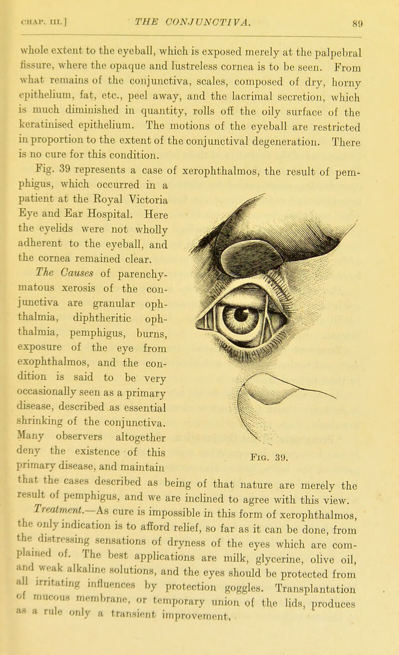whole extent to the eyeball, which is exposed merely at the palpebral tissure, where the opaque and lustreless cornea is to be seen. From what remains of the conjunctiva, scales, composed of dry, horny epithelium, fat, etc., peel away, and the lacrimal secretion, which is much diminished in quantity, rolls off the oily surface of the keratinised epithelium. The motions of the eyeball are restricted in proportion to the extent of the conjunctival degeneration. There is no cure for this condition. Fig. 39 represents a case of xerophthalmos, the result of pem- phigus, which occiu-red in a patient at the Koyal Victoria Eye and Ear Hospital. Here the eyelids were not wholly adherent to the eyeball, and the cornea remained clear. The Causes of parenchy- matous xerosis of the con- junctiva are granular oph- thalmia, diphtheritic oph- thalmia, pemphigus, burns, exposure of the eye from exophthalmos, and the con- dition is said to be very occasionally seen as a primary disease, described as essential shrinking of the conjunctiva. Many observers altogether deny the existence of this primary disease, and maintain that the cases described as being of that nature are merely the result of pemphigus, and we are inclined to agi-ee with this view. Trealmenl.—k% cure is impossible in this form of xerophthalmos, the only indication is to afford relief, so far as it can be done, from the di.stro8smg sensations of dryness of the eyes which are com- plained of. The best applications are milk, glycerine, olive oil, and weak alkaline solutions, and the eyes should be protected from a 1 irritating influences by protection goggles. Transplantation ot mucous membrane, or temporary union of the lids, produces as a rule only a tran.sient improvement. Fig. 39.