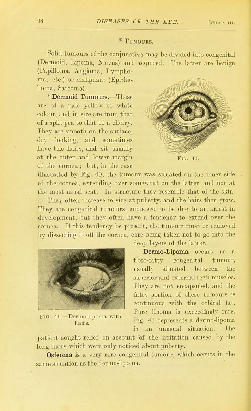 * Tumours. Fig. 40. Solid tumours of the conjunctiva may be divided into congenital (Dermoid, Lipoma, Nsevus) and acquired. The latter are benign (Papilloma, Angioma, Lympho- ma, etc.) or malignant (Epithe- lioma, Sarcoma). * Dermoid Tumours.—These are of a pale yellow or white colour, and in size are from that of a split pea to that of a cherry. They are smooth on the surface, dry looking, and sometimes have fine hairs, and sit usually at the outer and lower margin of the cornea ; but, in the case illustrated by Fig. 40, the tumour was situated on the inner side of the cornea, extending over somewhat on the latter, and not at the most usual seat. In structure they resemble that of the skin. They often increase in size at puberty, and the hairs then grow. They are congenital tumours, supposed to be due to an arrest in development, -but they often have a tendency to extend over the cornea. If this tendency be present, the tumour must be removed by dissecting it off the cornea, care being taken not to go into the deep layers of the latter. Dermo-Lipoma occurs as a fibro-fatty congenital tumour, usually situated between the superior and external recti muscles. They are not encapsuled, and the fatty portion of these tumours is continuous with the orbital fat. Pure lipoma is exceedingly rare. Fig. 41 represents a dermo-lipoma in an mmsual situation. The patient sought relief on account of the irritation caused by the long hairs which were only noticed about puberty. Osteoma is a very rare congenital tumour, which occurs in the same situation as the dermo-lipoma. Fig. 41. -Dermo-lipoma with hairs.
