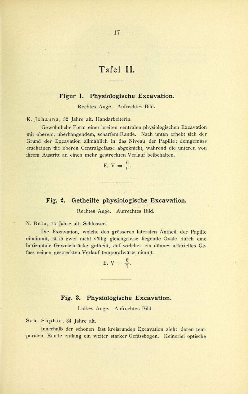 Tafel II. Figur 1. Physiologische Excavation. Rechtes Auge. Aufrechtes Bild. K. Johanna, 32 Jahre alt, Handarbeiterin. Gewöhnliche Form einer breiten centralen physiologischen Excavation mit oberem, überhängendem, scharfem Rande. Nach unten erhebt sich der Grund der Excavation allmählich in das Niveau der Papille; demgemäss erscheinen die oberen Centralgefässe abgeknickt, während die unteren von ihrem Austritt an einen mehr gestreckten Verlauf beibehalten. E,V = }. Fig. 2. Getheilte physiologische Excavation. Rechtes Auge. Aufrechtes Bild. N. Bela, 15 Jahre alt, Schlosser. Die Excavation, welche den grösseren lateralen Antheil der Papille einnimmt, ist in zwei nicht völlig gleichgrosse liegende Ovale durch eine horizontale Gewebsbrücke getheilt, auf welcher ein dünnes arterielles Ge- fäss seinen gestreckten Verlauf temporalwärts nimmt. K, V = j. Fig. 3. Physiologische Excavation. Linkes Auge. Aufrechtes Bild. Sch., Sophie, 34 Jahre alt. Innerhalb der schönen fast kreisrunden Excavation zieht deren tem- poralem Rande entlang ein weiter starker Gefässbogen. Keinerlei optische