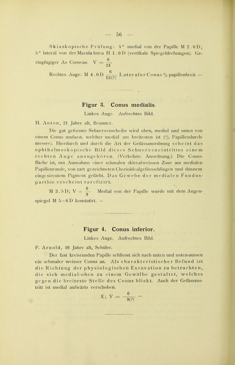 — 56 — Skiaskopische Prüfung: 5° medial von der Papille M 2. OD; 5 0 lateral von der Macula lutea H 1 . 0 D (vertikale Spiegeldrehungen). Ge- ringfügiger As Corneae. V = i Rechtes Auge: M 4. OD . L at er a 1 e r Conus 1ji papillenbreit.— Figur 3. Conus medialis. Linkes Auge. Aufrechtes Bild. H. Anton, 21 Jahre alt, Beamter. Die gut geformte Sehnervenscheibe wird oben, medial und unten von einem Conus urnfasst, welcher medial am breitesten ist Papillendurch- messer). Hierdurch und durch die Art der Gefässanordnung scheint das ophthalmoskopische Bild dieses Sehnerveneintrittes einem rechten Auge anzugehören. (Verkehrte Anordnung.) Die Conus- fläche ist, mit Ausnahme einer schmalen skleralweissen Zone am medialen Papillenrande, von zart gezeichneten Chorioidealgefässschlingen und dünnem eingc-sireutem Pigment gefärbt. Das Gewebe der medialen Fundus- parthie erscheint rarelizirt. M 3 . 5 D; V = Medial von der Papille wurde mit dem Augen- spiegel M 5 —6D konstatirt. — Figur 4. Conus inferior. Linkes Auge. Aufrechtes Bild. P. Arnold, 16 Jahre alt, Schüler. Der fast kreisrunden Papille schliesst sich nach unten und unten-aussen ein schmaler weisser Conus an. Als charakteristischer Befund ist die Richtung der physiologischen Excavation zu betrachten, die sich medial-oben zu einem Gewölbe gestaltet, welches gegen die breiteste Stelle des Conus blickt. Auch der Gefässaus- tritt ist medial aufwärts verschoben.