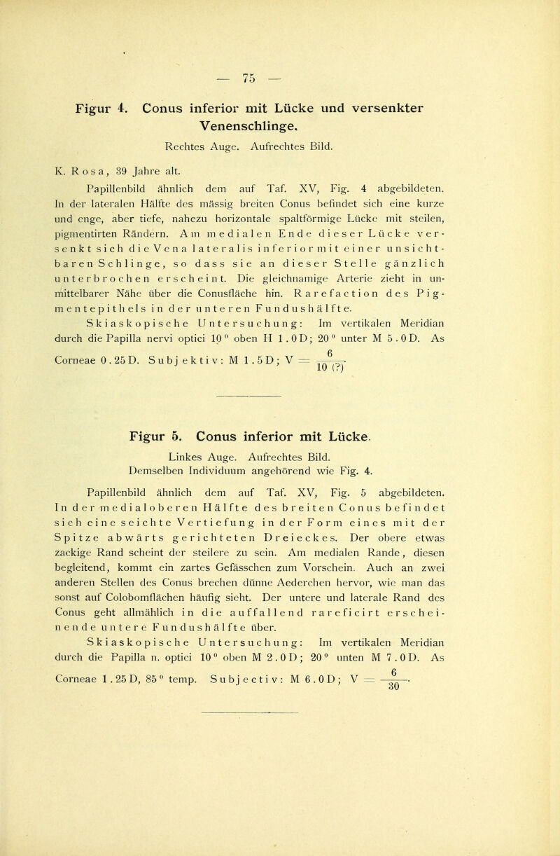 Figur 4. Conus inferior mit Lücke und versenkter Venenschlinge. Rechtes Auge. Aufrechtes Bild. K. Rosa, 39 Jahre alt. Papillenbild ähnlich dem auf Taf. XV, Fig. 4 abgebildeten. In der lateralen Hälfte des massig breiten Conus befindet sich eine kurze und enge, aber tiefe, nahezu horizontale spaltförmige Lücke mit steilen, pigmentirten Rändern. Am medialen Ende dieser Lücke ver- senkt sich dieVena lateralis inferior mit einer unsicht- bar e n S c h 1 i n g e , so dass sie an dieser Stelle gänzlich unterbrochen erscheint. Die gleichnamige Arterie zieht in un- mittelbarer Nähe über die Conusfläche hin. Rarefaction des Pig- mentepithels in der unteren Fun dushälft e. Skiaskopische Untersuchung: Im vertikalen Meridian durch die Papilla nervi optici 10 0 oben H I.OD; 20 0 unter M 5 .0 D. As Corneae 0 . 25 D. S u b j e k t i v : M 1 . 5 D ; V — —. Figur 5. Conus inferior mit Lücke. Linkes Auge. Aufrechtes Bild. Demselben Individuum angehörend wie Fig. 4. Papillenbild ähnlich dem auf Taf. XV, Fig. 5 abgebildeten. In der medialoberen Hälfte des breiten Conus befindet sich eine seichte Vertiefung in der Form eines mit der Spitze abwärts gerichteten Dreieckes. Der obere etwas zackige Rand scheint der steilere zu sein. Am medialen Rande, diesen begleitend, kommt ein zartes Gefässchen zum Vorschein. Auch an zwei anderen Stellen des Conus brechen dünne Aederchen hervor, wie man das sonst auf Colobomflächen häufig sieht. Der untere und laterale Rand des Conus geht allmählich in die auffallend rareficirt erschei- nende untere Fundushälfte über. Skiaskopische Untersuchung: Im vertikalen Meridian durch die Papilla n. optici 10 0 oben M 2 . 0 D ; 20 0 unten M 7 . 0 D. As Corneae 1 . 25 D, 85 0 temp. Subjectiv:M6.0D; V=