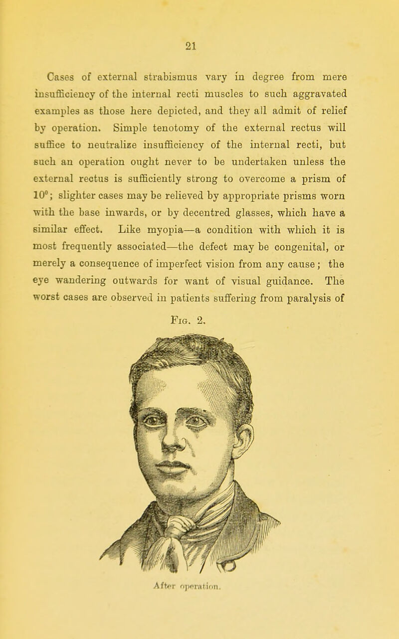Cases of external strabismus vary in degree from mere insufficiency of the internal recti muscles to such aggravated examples as those here depicted, and they all admit of relief by operation. Simple tenotomy of the external rectus will suffice to neutralize insufficiency of the internal recti, but such an operation ought never to be undertaken unless the external rectus is sufficiently strong to overcome a prism of 10°; slighter cases may be relieved by appropriate prisms worn with the base inwards, or by decentred glasses, which have a similar effect. Like myopia—a condition with which it is most frequently associated—the defect may be congenital, or merely a consequence of imperfect vision from any cause; the eye wandering outwards for want of visual guidance. The worst cases are observed in patients suffering from paralysis of Fig. 2. AfW oppratinn.