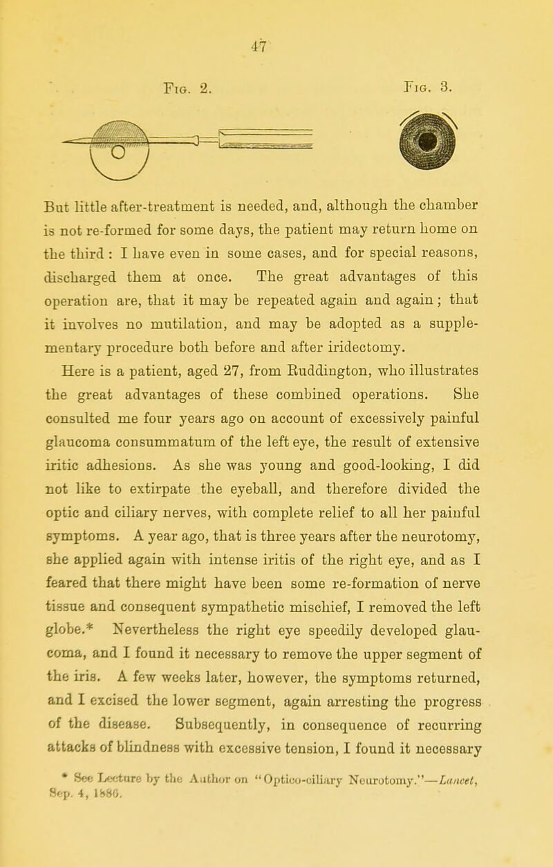 Fig. 2. Tig. 3. 3 But little after-treatment is needed, and, although the chamber is not re-formed for some days, the patient may return home on the third : I have even in some cases, and for special reasons, discharged them at once. The great advantages of this operation are, that it may be repeated again and again; that it involves no mutilation, and may be adopted as a supple- mentary procedure both before and after iridectomy. Here is a patient, aged 27, from Kuddington, who illustrates the great advantages of these combined operations. She consulted me four years ago on account of excessively painful glaucoma consummatum of the left eye, the result of extensive iritic adhesions. As she was young and good-looking, I did not like to extirpate the eyeball, and therefore divided the optic and ciliary nerves, with complete relief to all her painful symptoms. A year ago, that is three years after the neurotomy, she applied again with intense iritis of the right eye, and as I feared that there might have been some re-formation of nerve tissue and consequent sympathetic mischief, I removed the left globe.* Nevertheless the right eye speedily developed glau- coma, and I found it necessary to remove the upper segment of the iris. A few weeks later, however, the symptoms returned, and I excised the lower segment, again arresting the progress of the disease. Subsequently, in consequence of recurring attacks of blindness with excessive tension, I found it necessary • Bee Ij0OttU6 by the Author on  Optioo-olliary Neurotomy.—Lancet, Sep. 4, ij»80.