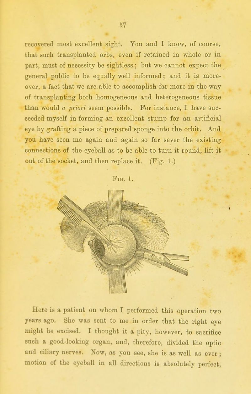 recovered most excellent sight. You aud I know, of course, that such transplanted orbs, even if retained in whole or in part, must of necessity be sightless; but we cannot expect the general public to be equally well informed; and it is more- over, a fact that we are.able to accomplish far more in the way of transplanting both homogeneous and heterogeneous tissue than would a priori seem possible. For instance, I have suc- ceeded myself in forming an excellent stump for an artificial eye by grafting a piece of prepared sponge into the orbit. And you have seen me again and again so far sever the existing connections of the eyeball as to be able to turn it round, lift it out of the socket, and then replace it. (Fig. 1.) Fig. 1. Here is a patient on whom I performed this operation two years ago. She was sent to me in order that the right eye might be excised. I thought it a pity, however, to sacrifice such a good-looking organ, and, therefore, divided the optic and ciliary nerves. Now, as you see, she is as well as ever; motion of the eyeball in all directions is absolutely perfect,