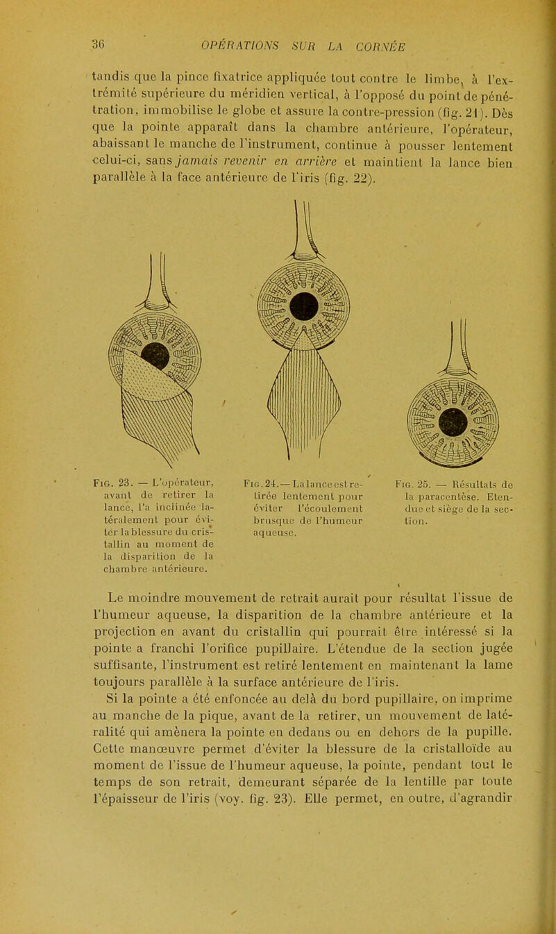 tandis que la pince fixatrice appliquée tout contre le limbe, à l'ex- trémité supérieure du méridien vertical, à l'opposé du pointdepéné- tralion, immobilise le globe et assure la contre-pression (fig. 21). Dès que la pointe apparaît dans la chambre antérieure, l'opérateur, abaissant le manche de l'instrument, continue à pousser lentement celui-ci, sans jamais revenir en arrière et maintient la lance bien parallèle à la face antérieure de l'iris (fig. 22). Fig. 23. — L'opérateur, avant do retirer la lancé, l'a inclinée la- téralement pour évi- ter lablessure du cris- tallin au moment de la disparition de la chambre antérieure. Fig. 24.— La lancées! re- tirée lentement pour éviter l'écoulement briisque de l'humeur aqueuse. Img. 25. — Résultats de la paracentèse. Elrii- due et siège de la sec- lion. Le moindre mouvement de retrait aurait pour résultat l'issue de l'humeur aqueuse, la disparition de la chambre antérieure et la projection en avant du cristallin qui pourrait être intéressé si la pointe a franchi l'orifice pupillaire. L'étendue de la section jugée suffisante, l'instrument est retiré lentement en maintenant la lame toujours parallèle à la surface antérieure de l'iris. Si la pointe a été enfoncée au delà du bord pupillaire, on imprime au manche de la pique, avant de la retirer, un mouvement de laté- ralité qui amènera la pointe en dedans ou en dehors de la pupille. Cette manœuvre permet d'éviter la blessure de la cristalloïde au moment de l'issue de l'humeur aqueuse, la pointe, pendant tout le temps de son retrait, demeurant séparée de la lentille par toute l'épaisseur de l'iris (voy. fig. 23). Elle permet, en outre, d'agrandir