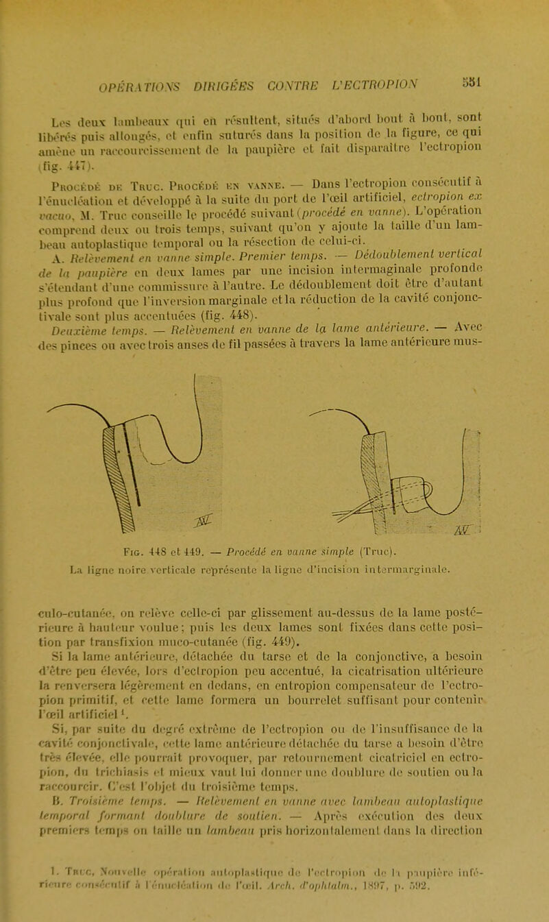 Les deux lambeaux qui en résultent, situés d'abord bout à bout, sont libérés puis allongés, et enfin suturés dans la position de la figure, ce qui amène un raceoureisseinent de la paupière et fait disparaître l'ectropion (fig. 447). Pkocédé de Truc. Puockuk en vanne. — Dans l'ectropion consécutif a l'énucléatiou et développé à la suite du port de l'œil artificiel, eclropionex vacuo, M. Truc conseille le procédé suivant (procédé en vanne). L'opération comprend deux ou trois temps, suivant qu'on y ajoute la taille d'un lam- beau antoplastique temporal ou la résection de celui-ci. A. Relèvement en vanne simple. Premier temps. — Dédoublement vertical de la paupière en deux lames par une incision intermaginalc profonde, s étendant d'une commissure à l'autre. Le dédoublement doit être d'autant plus profond que l'inversion marginale et la réduction de la cavité conjonc- tivale sont plus accentuées (fig. 448). Deuxième temps. — Relèvement en vanne de la lame antérieure. — Avec des pinces on avec trois anses de fil passées à travers la lame antérieure mus- Fig. 448 et 449. — Procédé en vanne simple (Truc). La ligne noire verticale représente la ligne d'incision intermarginale. culo-cutanée, on relève celle-ci par glissement au-dessus de la lame posté- rieure à hauteur voulue; puis les deux lames sont fixées dans cette posi- tion par transfixion mneo-cutanée (fig. 449). Si la lame antérieure, détachée du tarse et de la conjonctive, a besoin d'être peu élevée, lors d'eclropion peu accentué, la cicatrisation ultérieure la nnversera légèrement en dedans, en entropion compensateur de l'ectro- pion primitif, et cette lame formera un bourrelet suffisant pour contenir l'œil artificiel '. Si, par suite du degré extrême de l'ectropion ou de l'insuffisance de la cavité conjonctivale, cette lame antérieure détachée du tarse a besoin d'être très élevée, elle pourrait provoquer, par retournement, cicatriciel en ectro- pion, du trichiasis et mieux vaut lui donner une doublure de soutien ou la raccourcir, (est l'objet du troisième temps. H. Troisième temps. — Relèvement en vanne avec lambeau auloplastique temporal formant doublure de soutien. — Après exécution des deux premiers temps ou taille un lambeau pris horizontalement dans la direction I. Truc, Nouvelle opération nutoplastlque do l'ectropion de la paupière Infé- rfeure eotuéeuitt à rémictéallon de Parti. Areh. d'ophtalm., 1897, p. .>!i2.