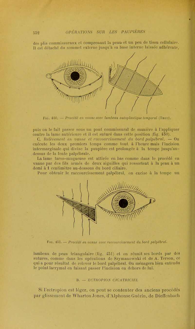 §52 des plis commissuraux el comprenant la peau-ct un peu de tissu cellulaire Il esl détaché du somme! externe jusqu'à sa base interne laissée adhérente Fig. 450. — Procédé en vanne avec lambeau auloplastique temporal (Tnuc). puis on le fait passer sous un pont commissural de manière à l'appliquer contre la lame antérieure el il est suluré clans cette position (fig. 450). G. Relèvement en vanne el raccourcissement du bord palpébral. — On exécute les deux premiers temps comme tout à l'heure mais l'incision intermarginale qui divise la paupière est prolongée à la tempe jusqu'au- dessus de la fente palpébrale. La lame larsc—muqueuse est attirée en bas comme dans le procédé en vanne par des fils armés de deux aiguilles qui ressortent à la peau à un demi à 1 centimètre au-dessous du bord ciliaire. Pour obtenir le raccourcissement palpébral, on excise a la tempe un Fig. 451. — Procédé en vanne avec raccourcissement du bord palpébral. lambeau de peau triangulaire (fig. 451) et on réunit ses bords par des sutures, comme dans les opérations de Szymanowski et de A. ïerson, ce qui a pour résultat de relever le bord palpébral. On ménagera bien entendu le point lacrymal en faisant passer l'incision en dehors de lui. 13. — ECTROPION CICATRICIEL Si l'ectropion est léger, on peut se contenter des anciens procédés par glissement de Wharton Jones, d'Alphonse Guérin, de Dieffenbach