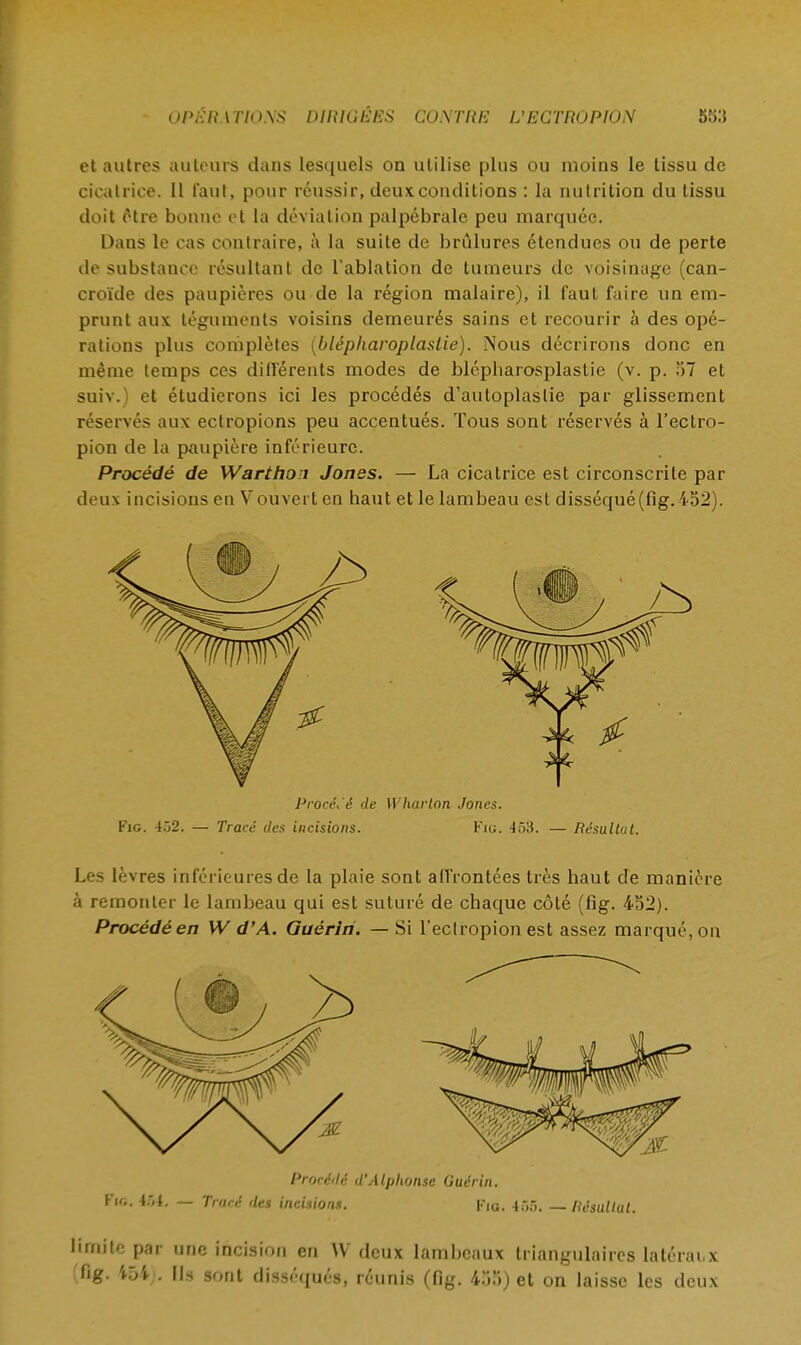 et autres auteurs dans lesquels on utilise plus ou moins le tissu de cicatrice. Il faut, pour réussir, deux conditions : la nutrition du tissu doit être bonne et la déviation palpébrale peu marquée. Dans le cas contraire, à la suite de brûlures étendues ou de perte de substance résultant de l'ablation de tumeurs de voisinage (can- croïde des paupières ou de la région malaire), il faut faire un em- prunt aux téguments voisins demeurés sains et recourir à des opé- rations plus complètes (blépharoplastie). Nous décrirons donc en même temps ces différents modes de blépbarosplastie (v. p. 57 et suiv.) et étudierons ici les procédés d'autoplaslie par glissement réservés aux ectropions peu accentués. Tous sont réservés à l'ectro- pion de la paupière inférieure. Procédé de Warthoi Jones. — La cicatrice est circonscrite par deux incisions en V ouvert en haut et le lambeau est disséqué(fig. 452). Procédé de Wharlon Jones. Fig. 452. — Tracé des incisions. Fia. 453. — Résultat. Les lèvres inférieures de la plaie sont affrontées très haut de manière à remonter le lambeau qui est suturé de chaque côté (fig. 452). Procédé en W d'A. Guériri. —Si l'eclropion est assez marqué, on Fig. 454. — Tracé des incisions. Procédé d'Alphonse Guérin. Fig. 455. — Résultat. limite par une incision en W deux lambeaux triangulaires latéraux fig. i54;. Ils sont disséqués, réunis (fig. 455) et on laisse les deux