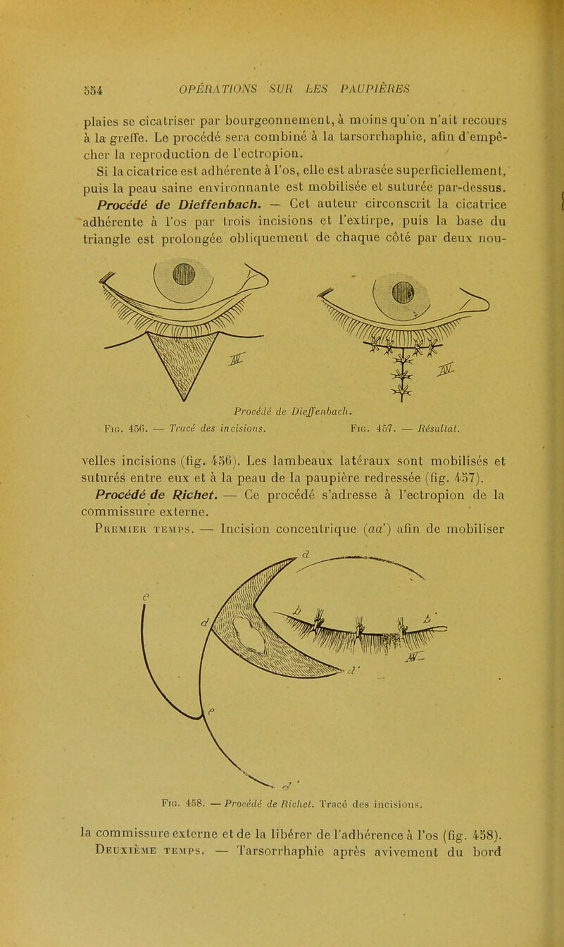 plaies se cicalriser par bourgeonnement, à moins qu'on n'ait recours à la greffe. Le procédé sera combiné à la tarsorrhaphie, afin d'empê- cher la reproduction de l'eclropion. Si la cicatrice est adhérente à l'os, elle est abrasée superficiellement, puis la peau saine environnante est mobilisée et suturée par-dessus. Procédé de Dieffenbach. — Cet auteur circonscrit la cicatrice adhérente à l'os par trois incisions et l'extirpe, puis la base du triangle est prolongée obliquement de chaque côté par deux nou- velles incisions (fig. 456). Les lambeaux latéraux sont mobilisés et suturés entre eux et à la peau de la paupière redressée (fig. 457). Procédé de Pichet. — Ce procédé s'adresse à l'ectropion de la commissure externe. Premier temps. — Incision concentrique (aa') afin de mobiliser Fig. 458. — Procédé de Ricliet. Tracé clos incisions. la commissure externe et de la libérer de l'adhérence à l'os (fig. 458). Deuxième temps. — Tarsorrhaphie après avivement du bord