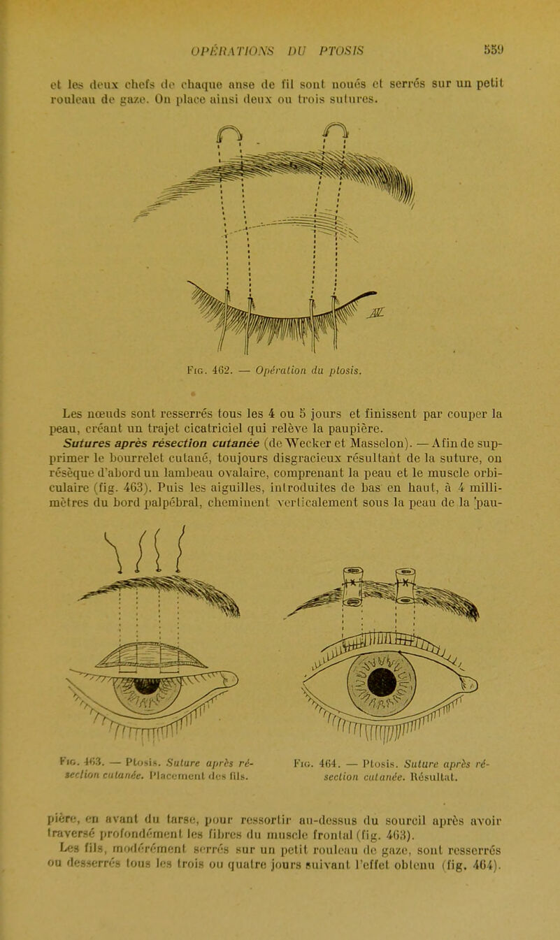 et les deux chofs clo chaque nnse de fil sont noués et serrés sur un petit rouleau de gaze. On place ainsi deux ou trois sutures. Fig. 462. — Opération du ptosis. Les nœuds sont resserrés tous les 4 ou 5 jours et finissent par couper la peau, créant un trajet cicatriciel qui relève la paupière. Sutures après résection cutanée (de Wecker et Masselon). —Afin de sup- primer le bourrelet cutané, toujours disgracieux résultant de la suture, on résèque d'abord un lambeau ovalaire, comprenant la peau et le muscle orbi- culaire (fig. 463). Puis les aiguilles, introduites de bas en haut, à 4 milli- mètres du bord palpébral, cheminent verticalement sous la peau de la 'pau- Fio. 463. — Ptosis. Suture après ré- Fig. 464. — Ptosis. Suture après ré- section cutanée. Placement des fils. section cutanée. Résultat pière, en avant du tarse, pour ressortir au-dessus du sourcil après avoir traversé profondément les fibres du muscle frontal (fig. 403). Les fils, modérément serrés sur un petit rouleau de gaze, sont resserrés ou desserrés tous les trois ou quatre jours suivant l'effet obtenu (fig. 464).