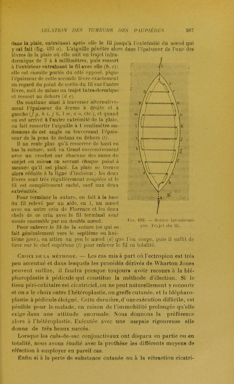 il dans la plaie, entraînant après die le fil jusqu'à ruxlrémilé du nœud qui y est fait (fig. 493 a). L'aiguille pénètre alors dans l'épaisseur de l'une des lèvres de la plaie où elle suit un trajet intra- dermique de 3 à 4 millimètres, puis ressort à l'extérieur entraînant le fil avec elle (6. c); elle est ensuite portée du côté opposé, pique l'épaisseur de cette seconde lèvre exactement eu regard du point de sortie du fil sur l'autre lèvre, suit de même un trajet inlra-dermique et ressort au dehors (d e). On continue aiusi à traverser alternative- ment l'épaisseur du derme à droite et à gauche(/ g, h i, j k, l m, n o, etc.), et quand on est arrivé à l'autre extrémité de la plaie, ou fait ressortir l'aiguille à 1 centimètre au- dessous de cet angle en traversant l'épais- seur de la peau de dedans en dehors (t). 11 ne reste plus qu'à resserrer de haut en bas la suture, soit en tirant successivement avec un crochet sur chacune des anses du surjet ou niieuac en serrant chaque point à mesure qu'il est placé. La plaie so trouve alors réduite à la ligne d'incision ; les deux lèvres sont très régulièrement coaptées et le fil est complètement caché, sauf aux deux extrémités. Pour terminer la suture, on fait à la hase du fil relevé par uu aide, en t, un nœud avec un autre crin de Florence et les deux chefs de ce crin avec le fil terminal sont noués ensemble par uu double nœud. Pour enlever le fil de la suture (ce qui so fait généralement vers le septième ou hui- tième jour;, on attire un peu le uœud (a) que l'on coupe, puis il suffit de tirer sur le chef supérieur (l) pour enlever le fil en totalité. Choix de la méthode. — Les cas misa part où l'ectropion est très peu accentué et dans lesquels les procédés dérivés de Wharton Jones peuvent suffire, il faudra presque toujours avoir recours à la blé- pharoplastie à pédicule qui constitue la méthode d'élection. Si le tissu péri-orbi taire est cicatriciel, on ne peut naturellement y recourir et on a le choix entre l hctéroplastie. ou greffe cutanée, et la blépharo- plastte à pédicule éloigne, dette dernière,d'uneexécution difficile, est pénible pour le malade, en raison de l'immobilité prolongée quelle exige dans une attitude anormale. Nous donnons la préférence alors à l'hétcroplastie. Exécutée avec une asepsie rigoureuse elle donne de très beaux succès. Lorsque le» culs-de-sac conjonctivaux ont disparu en partie ou en totalité, nous avons étudié avec la prothèse les différents moyens de réfection k employer en pareil cas. Enfin si à la perte de substance cutanée ou k la rétraction cicatri- i'Sà. — Sutura liilradermi* que. Trajet di| lil.