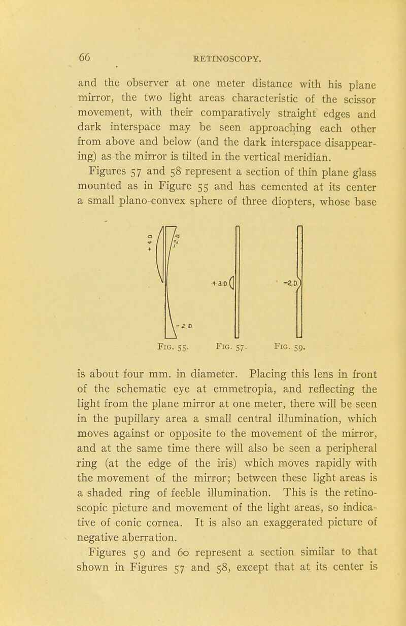 and the observer at one meter distance with his plane mirror, the two light areas characteristic of the scissor movement, with their comparatively straight edges and dark interspace may be seen approaching each other from above and below (and the dark interspace disappear- ing) as the mirror is tilted in the vertical meridian. Figures 57 and 58 represent a section of thin plane glass mounted as in Figure 55 and has cemented at its center a small plano-convex sphere of three diopters, whose base 1 + ao(| ) Fig. 55. Fig. 57. Fig. 59. is about four mm. in diameter. Placing this lens in front of the schematic eye at emmetropia, and reflecting the light from the plane mirror at one meter, there will be seen in the pupillary area a small central illumination, which moves against or opposite to the movement of the mirror, and at the same time there will also be seen a peripheral ring (at the edge of the iris) which moves rapidly with the movement of the mirror; between these light areas is a shaded ring of feeble illumination. This is the retino- scopic picture and movement of the light areas, so indica- tive of conic cornea. It is also an exaggerated picture of negative aberration. Figures 59 and 60 represent a section similar to that shown in Figures 57 and 58, except that at its center is