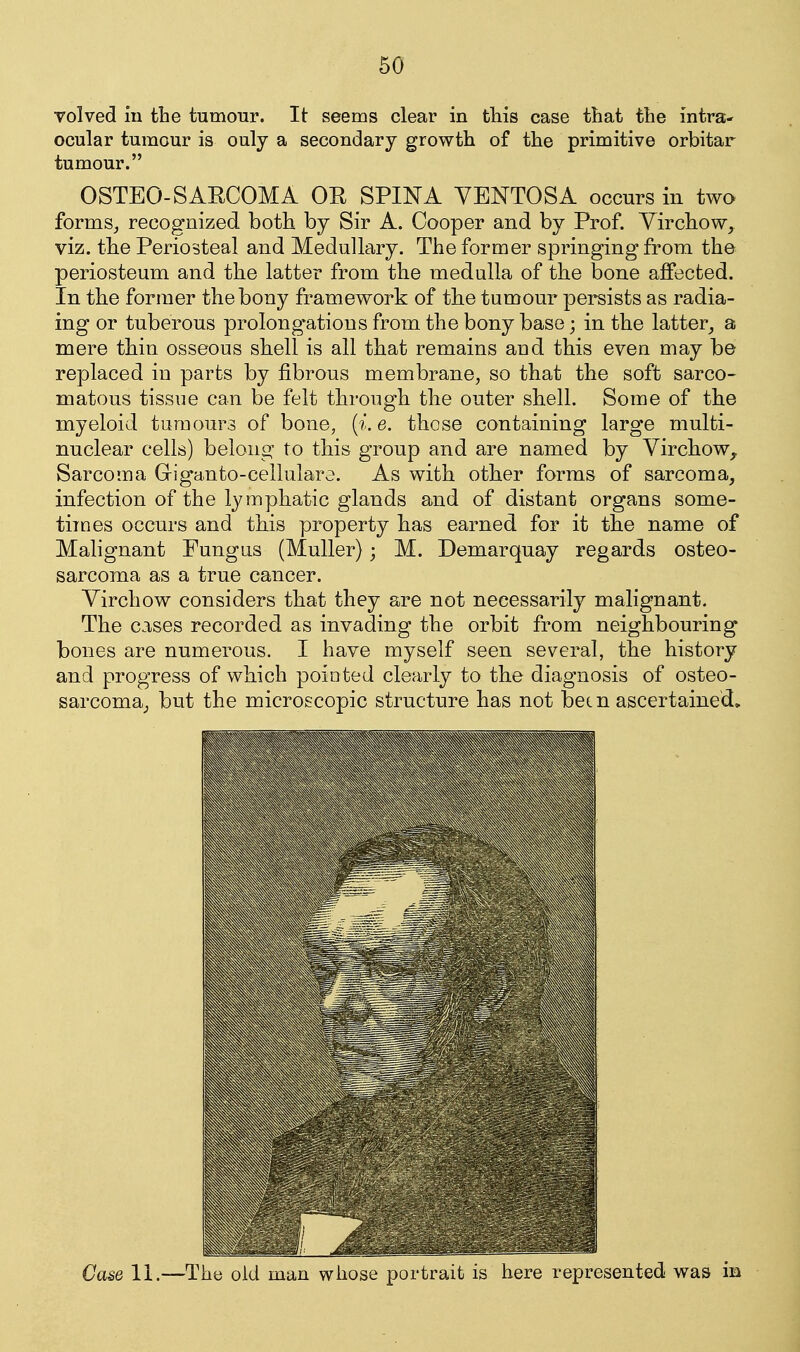 volved in the tumour. It seems clear in this case that the intra- ocular tumour is only a secondary growth of the primitive orbitar tumour. OSTEO-SARCOMA OR SPINA YENTOSA occurs in two forms^ recognized both by Sir A. Cooper and by Prof. Virchow, viz. the Periosteal and Medullary. The former springing from the periosteum and the latter from the medulla of the bone affected. In the former the bony framework of the tumour persists as radia- ing or tuberous prolong*atious from the bony base; in the latter^ a mere thin osseous shell is all that remains aud this even may be replaced in parts by fibrous membrane, so that the soft sarco- matous tissue can be felt through the outer shell. Some of the myeloid tumours of bone, (i.e. those containing large multi- nuclear cells) belong to this group and are named by Yirchow, Sarcoma Giganto-cellulare. As with other forms of sarcoma, infection of the lymphatic glands and of distant organs some- times occurs and this property has earned for it the name of Mahgnant Fungus (Muller); M. Demarquay regards osteo- sarcoma as a true cancer. Virchow considers that they are not necessarily malignant. The C3,ses recorded as invading the orbit from neighbouring bones are numerous. I have myself seen several, the history and progress of which pointed clearly to the diagnosis of osteo- sarcoma_, but the microscopic structure has not been ascertained. Case 11.—The old man whose puriraii i;s iiere represented was in