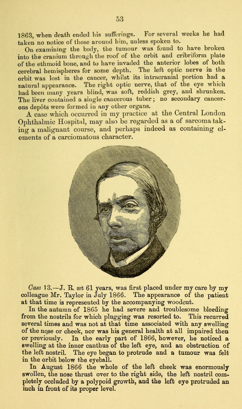 1863, when death ended hia sufferings. For several weeks he had taken no notice of those around him, unless spoken to. On examining the body, the tumour was found to have broken into the cranium through the roof of the orbit and cribriform plate of the ethmoid bone, and to have invaded the anterior lobes of both cerebral hemispheres for some depth. The left optic nerve in the orbit was lost in the cancer, whilst its intracranial portion bad a natural appearance. The right optic nerve, that of the eye which had been many years blind, was soft, reddish grey, and shrunken. The liver contained a single cancerous tuber; no secondary cancer- ous depots were formed in any other organs. A case which occurred in my practice at the Central London Ophthalmic Hospital, may also be regarded as a of sarcoma tak- ing a malignant course, and perhaps indeed as containing el- ements of a carciomatous character. Case 13.—J. R. get 61 years, was first placed under my care by my colleague Mr. Taylor in July 1866. The appearance of the patient at that time is represented by the accompanying woodcut. In the autumn of 1865 he had severe and troublesome bleeding from the nostrils for which plugging was resorted to. This recurred several times and was not at that time associated with any swelling of the nqse or cheek, nor was his general health at all impaired then or previously. In the early part of 1866, however, he noticed a swelling at the inner can thus of the left eye, and an obstruction of the left nostril. The eye began to protrude and a tumour was felt in the orbit below the eyeball. In August 1866 the whole of the left cheek was enormously swollen, the nose thrust over to the right side, the left nostril com- pletely occluded by a polypoid growth, and the left eye protruded an inch in front of its proper level.