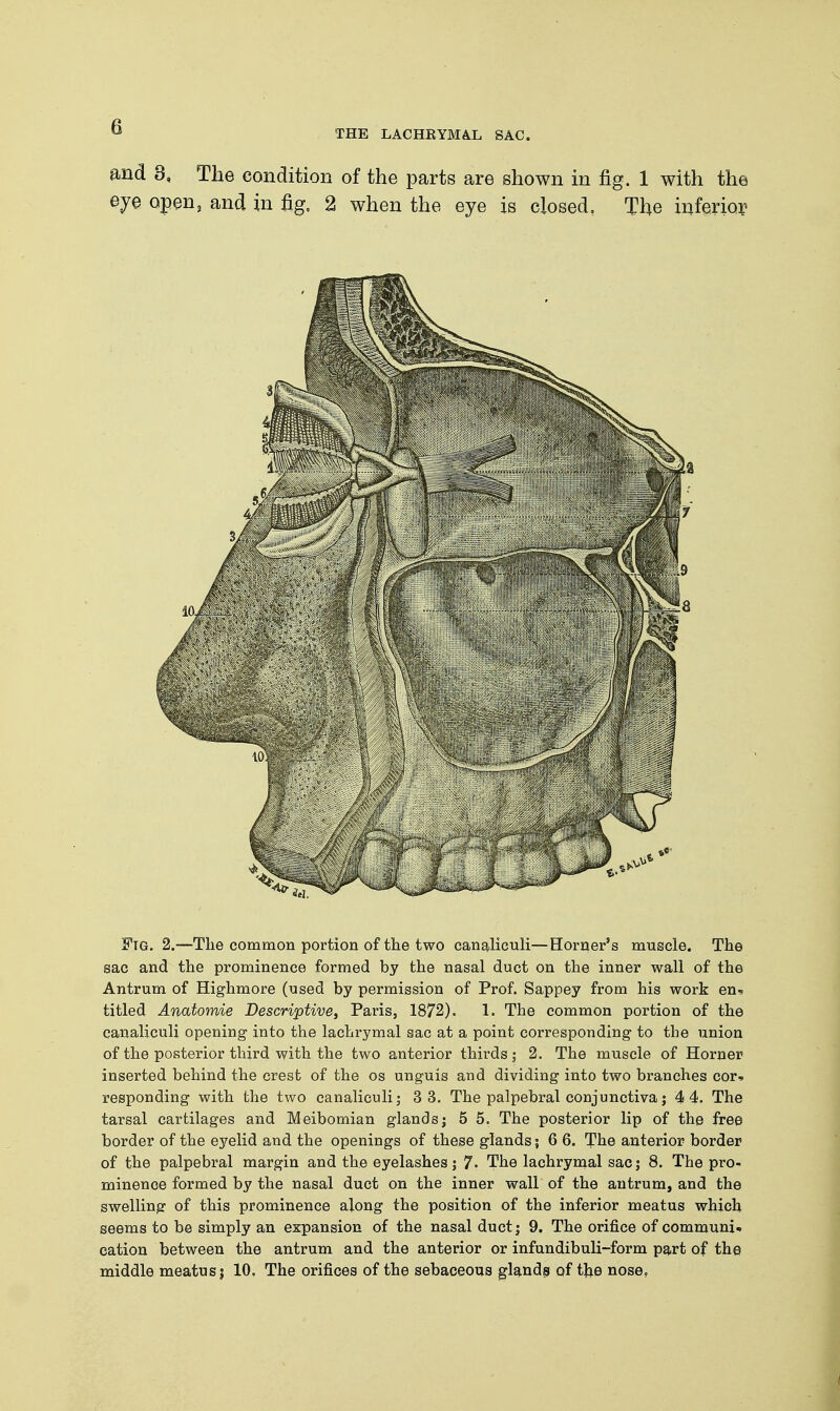 THE LACHRYMAL SAC. and 3, The condition of the parts are shown in fig. 1 with the eye open, and in fig, 2 when the eye is closed, The inferior- Fig. 2.—The common portion of the two canaliculi—Horner's muscle. The sac and the prominence formed by the nasal duct on the inner wall of the Antrum of Highmore (used by permission of Prof. Sappey from his work en* titled Anatomie Descriptive, Paris, 1872). 1. The common portion of the canaliculi opening into the lachrymal sac at a point corresponding to the union of the posterior third with the two anterior thirds; 2. The muscle of Horner inserted behind the crest of the os unguis and dividing into two branches cor* responding with the two canaliculi; 3 3. The palpebral conjunctiva; 4 4. The tarsal cartilages and Meibomian glands; 5 5. The posterior lip of the free border of the eyelid and the openings of these glands; 6 6. The anterior border of the palpebral margin and the eyelashes; 7. The lachrymal sac; 8. The pro- minence formed by the nasal duct on the inner wall of the antrum, and the swelling of this prominence along the position of the inferior meatus which seems to be simply an expansion of the nasal duct; 9. The orifice of communis cation between the antrum and the anterior or infundibuli-form part of the middle meatus; 10. The orifices of the sebaceous glands of the nose.