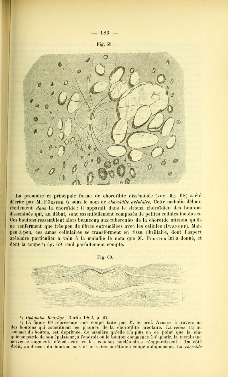 Fig-. 68. La première et principale forme de choroïdite disséminée (voy. fig. 68) a été décrite par M. Fôrster i) sous le nom de choroïdite aréolaîre. Cette maladie débute réellement dans la choroïde; il apparaît dans le stroma choroïdien des boutons disséminés qui, au début, sont essentiellement composés de petites cellules incolores. Ces boutons ressemblent alors beaucoup aux tubercules de la choroïde attendu qu'ils ne renferment que très-peu de fibres entremêlées avec les cellules (Iwanoff). Mais peu-à-peu, ces amas cellulaires se transforment en tissu fibrillaire, dont l'aspect aréolaire particulier a valu à la maladie le nom que M. Fôrster lui a donné, et dont la coupe 2) fig. 69 rend parfaitement compte. Fig. 69. ^) Ophlhalm. lîeitvagc, Berlin 1862, p. 97. ) La figure 69 représente une coupe faite par M. le prof Aubert à travers un des boutons qui constituent les plaques de la choroïdite aréolaire. La rétine (a) au sommet du bouton, est déprimée, de manière qu'elle n'a plus en ce point que la cin- quième partie de son épaisseur; à l'endroit on le bouton commence à s'aplatir, la membrane nerveuse augmente d'épaisseur, et les couches nucléohiires réapparaissent. Du côté droit, au-dessus du bouton, se voit un vaisseau rétinien coupé obliquement. La choroïde