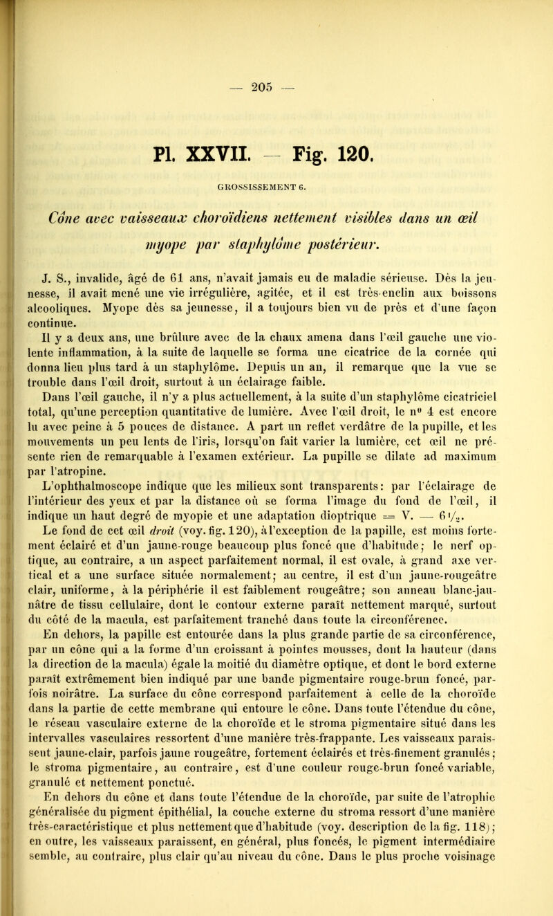 Pl. XXVII. Fig. 120. GROSSISSEMENT 6. Cône avec vaisseaux choroïdiens nettement visibles dans un œil J. S., invalide, âgé de 61 ans, n'avait jamais eu de maladie sérieuse. Dès la jeu- nesse, il avait mené une vie irrégulière, agitée, et il est très-enclin aux b(ûssons alcooliques. Myope dès sa jeunesse, il a toujours bien vu de près et d'une façon continue. Il y a deux ans, une brûlure avec de la chaux amena dans l'œil gauche une vio- lente inflammation, à la suite de laquelle se forma une cicatrice de la cornée qui donna lieu plus tard à un staphylôme. Depuis un an, il remarque que la vue se trouble dans l'œil droit, surtout à un éclairage faible. Dans l'œil gauche, il n'y a plus actuellement, à la suite d'un staphylôme cicatriciel total, qu'une perception quantitative de lumière. Avec l'œil droit, le n» 4 est encore lu avec peine à 5 pouces de distance. A part un reflet verdâtre de la pupille, et les mouvements un peu lents de l'iris, lorsqu'on fait varier la lumière, cet œil ne pré- sente rien de remarquable à l'examen extérieur. La pupille se dilate ad maximum par l'atropine. L'oplithalmoscope indique que les milieux sont transparents : par l'éclairage de l'intérieur des yeux et par la distance où se forma l'image du fond de l'œil, il indique un haut degré de myopie et une adaptation dioptrique =^ V. — 6</^. Le fond de cet œil droit (voy. fig. 120), à l'exception de la papille, est moins forte- ment éclairé et d'un jaune-rouge beaucoup plus foncé que d'habitude; le nerf op- tique, au contraire, a un aspect parfaitement normal, il est ovale, à grand axe ver- tical et a une surface située normalement,* au centre, il est d'un jaune-rougeâtre clair, uniforme, à la périphérie il est faiblement rougeâtre,* son anneau blanc-jau- nâtre de tissu cellulaire, dont le contour externe paraît nettement marqué, surtout du côté de la macula, est parfaitement tranché dans toute la circonférence. En dehors, la papille est entourée dans la plus grande partie de sa circonférence, par un cône qui a la forme d'un croissant à pointes mousses, dont la hauteur (dans la direction de la macula) égale la moitié du diamètre optique, et dont le bord externe paraît extrêmement bien indiqué par une bande pigmentaire rouge-brun foncé, par- fois noirâtre. La surface du cône correspond parfaitement à celle de la choroïde dans la partie de cette membrane qui entoure le cône. Dans toute l'étendue du cône, le réseau vasculaire externe de la choro'ide et le stroma pigmentaire situé dans les intervalles vasculaires ressortent d'une manière très-frappante. Les vaisseaux parais- sent jaune-clair, parfois jaune rougeâtre, fortement éclairés et très-finement granulés; le stroma pigmentaire, au contraire, est d'une couleur rouge-brun foncé variable, granulé et nettement ponctué. En dehors du cône et dans toute l'étendue de la choro'ide, par suite de l'atrophie généralisée du pigment épithélial, la couche externe du stroma ressort d'une manière très-caractéristique et plus nettement que d'habitude (voy. description de la fig. 118), en outre, les vaisseaux paraissent, en général, plus foncés, le pigment intermédiaire semble, au contraire, plus clair qu'au niveau du cône. Dans le plus proche voisinage myope