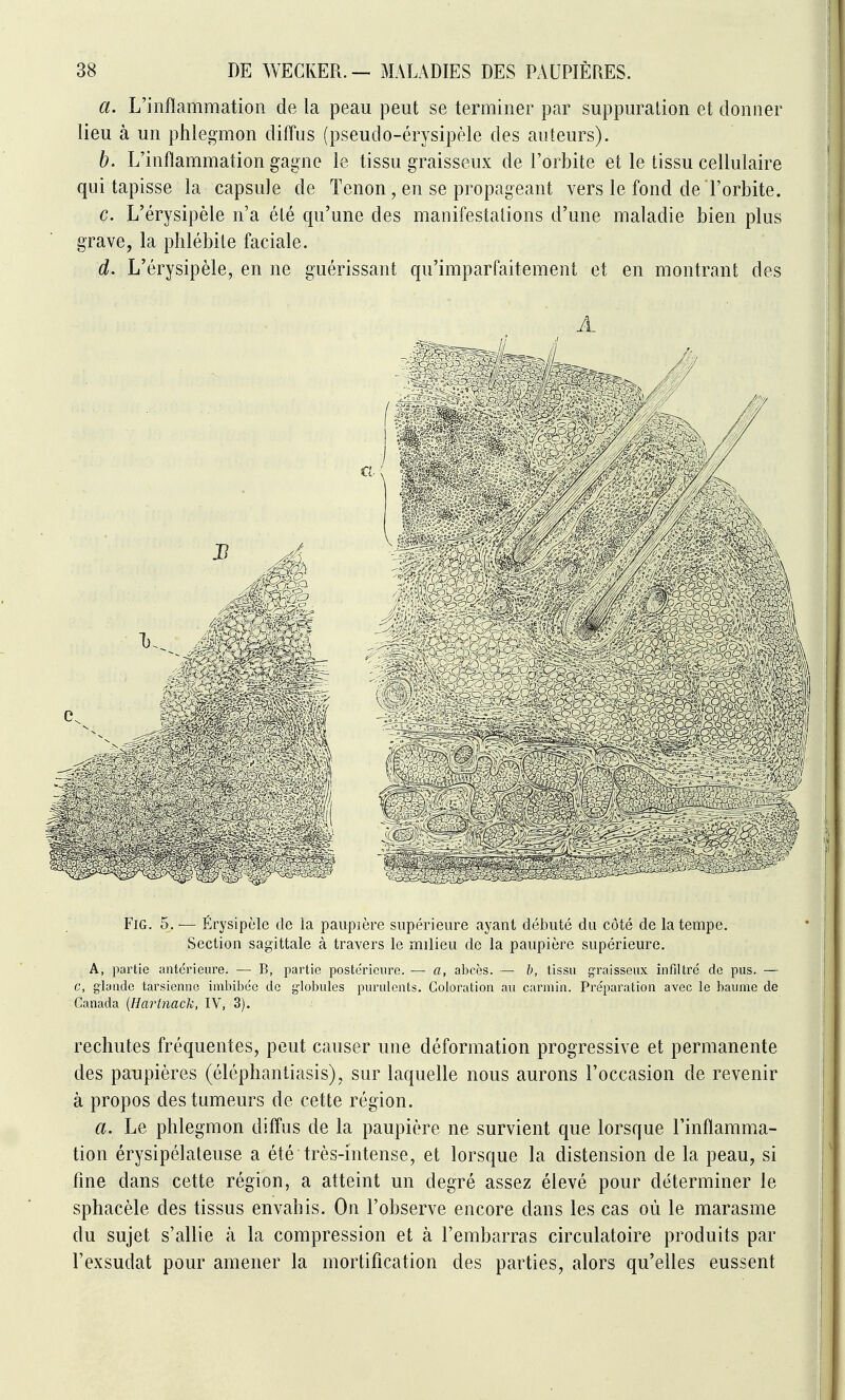 a. L'inflammation de la peau peut se terminer par suppuration et donner lieu à un phlegmon diffus (pseudo-érysipèle des auteurs). h. L'inflammation gagne le tissu graisseux de l'orbite et le tissu cellulaire qui tapisse la capsule de Tenon, en se propageant vers le fond de l'orbite. c. L'érysipèle n'a été qu'une des manifestations d'une maladie bien plus grave, la phlébite faciale. d. L'érysipèle, en ne guérissant qu'imparfaitement et en montrant des FiG. 5. — Érysipèle de ia paupière supérieure ayant débuté du côté de la tempe. Section sagittale à travers le milieu de la paupière supérieure. A, partie antérieure. — B, partie poste'ricure. — a, abcès. — b, tissu graisseux infiltre de pus. — c, glande tarsienne imbii)éc de globules purulents. Coloration au carmin. Pre'paration avec le baume de Canada {Harlnack, IV, 3). rechutes fréquentes, peut causer une déformation progressive et permanente des paupières (éléphantiasis), sur laquelle nous aurons l'occasion de revenir à propos des tumeurs de cette région. a. Le phlegmon diffus de la paupière ne survient que lorsque l'inflamma- tion érysipélateuse a été très-intense, et lorsque la distension de la peau, si fine dans cette région, a atteint un degré assez élevé pour déterminer le sphacèle des tissus envahis. On l'observe encore dans les cas où le marasme du sujet s'allie à la compression et à l'embarras circulatoire produits par l'exsudat pour amener la mortification des parties, alors qu'elles eussent